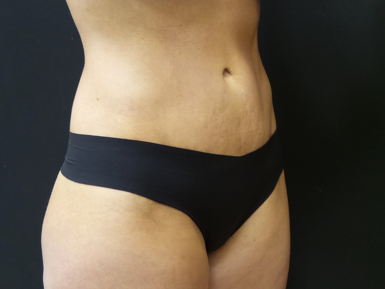Tummy Tuck Before & After