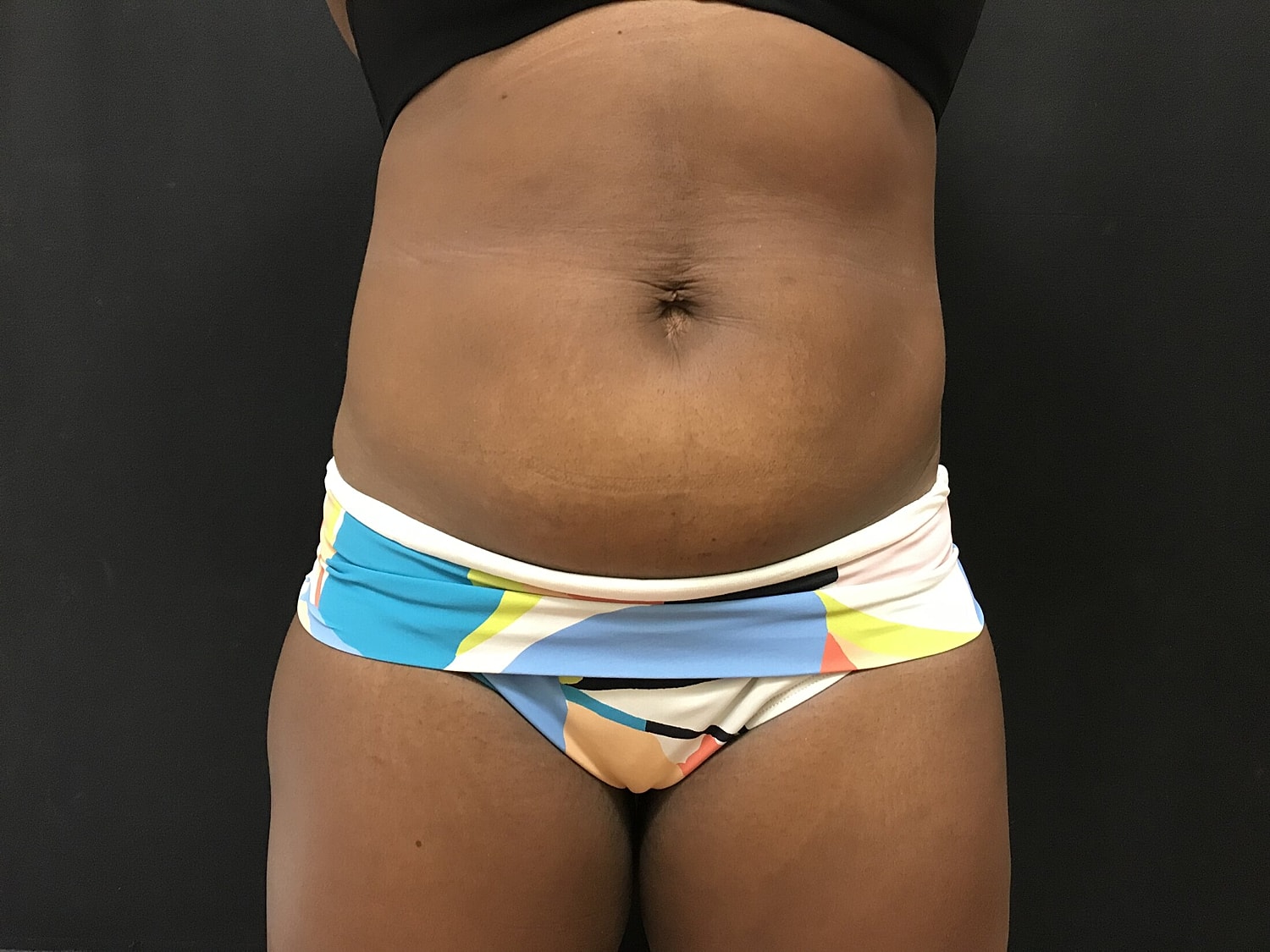 Tummy Tuck Before & After
