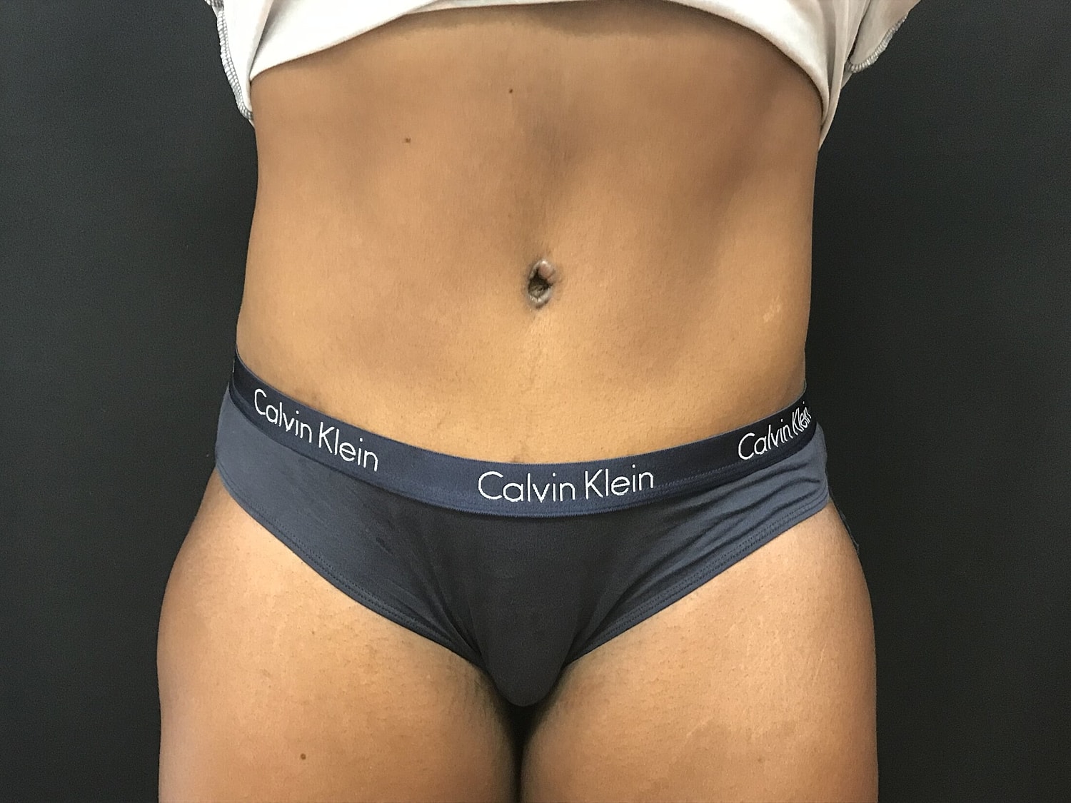 Tummy Tuck Before & After