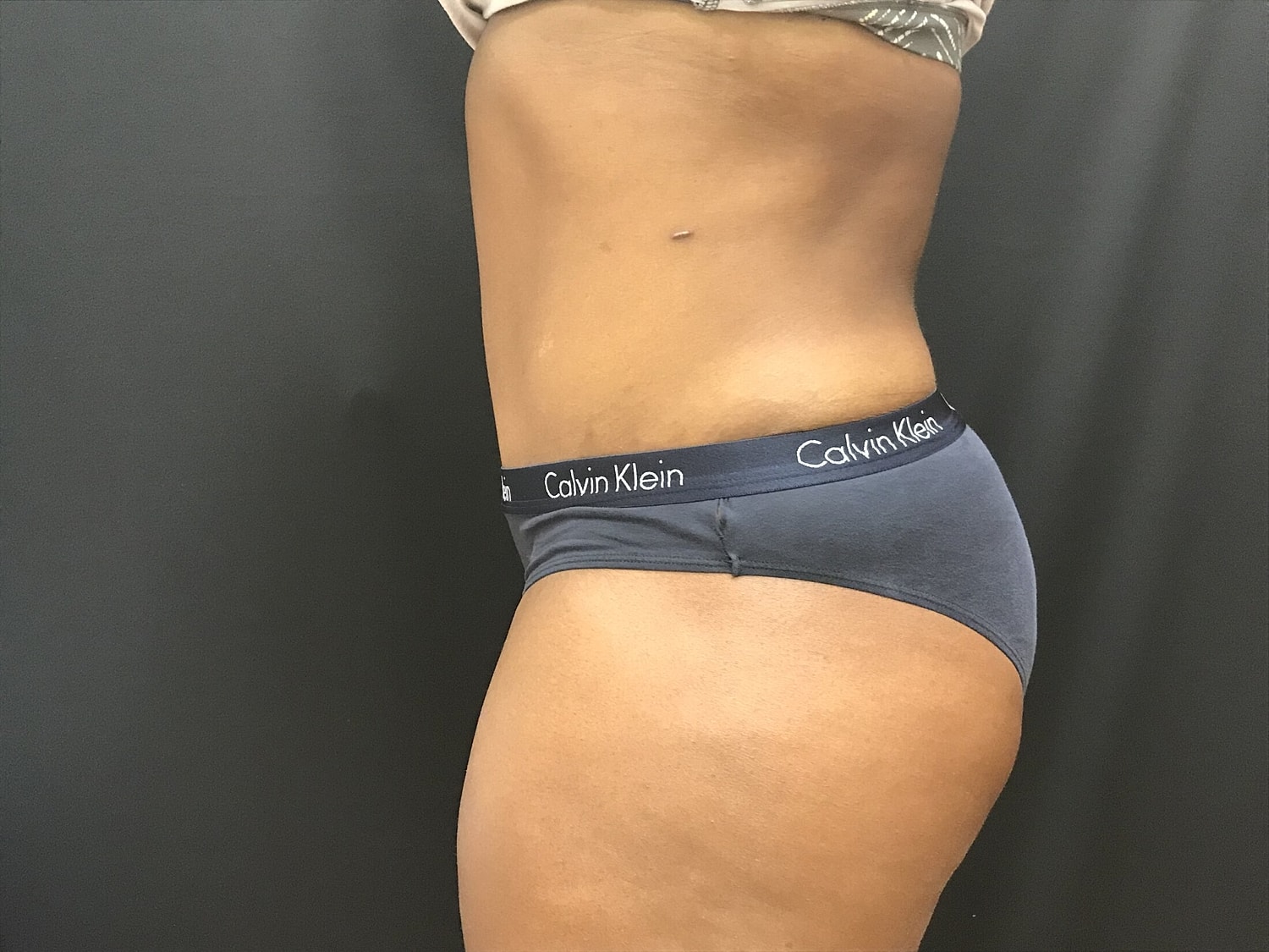 Tummy Tuck Before & After