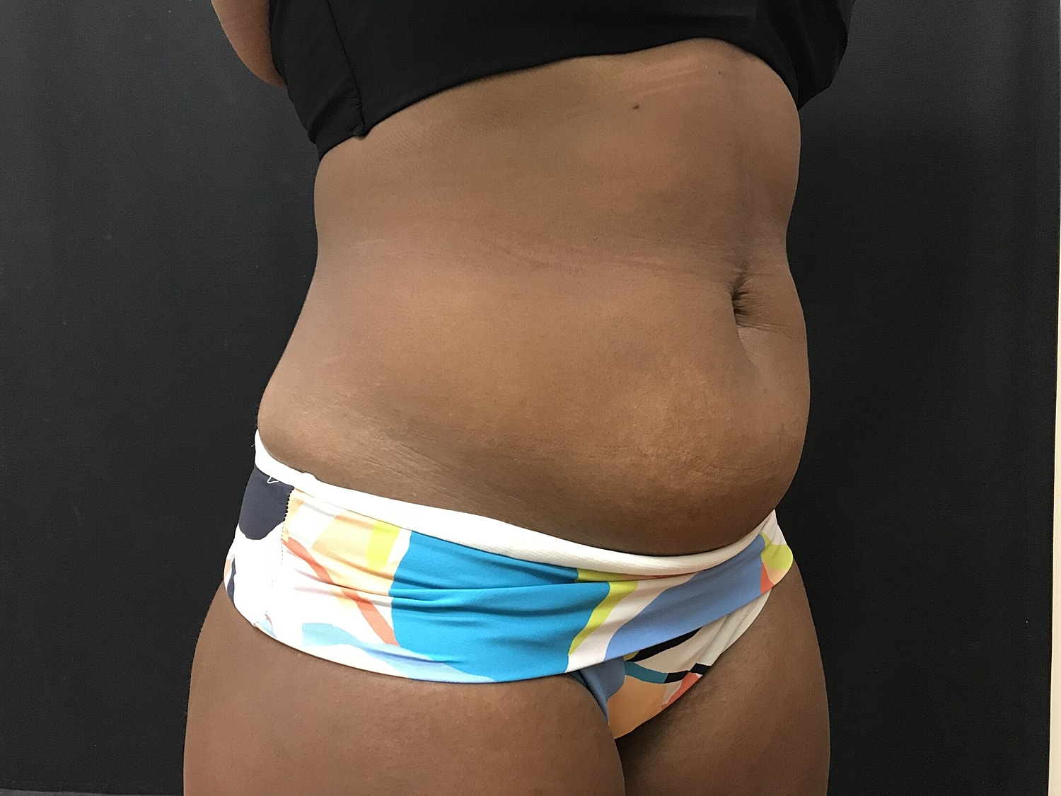 Tummy Tuck Before & After
