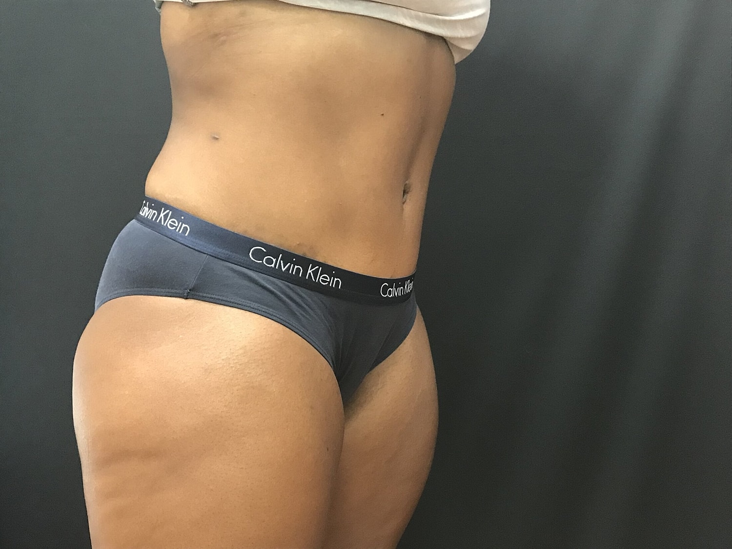 Tummy Tuck Before & After