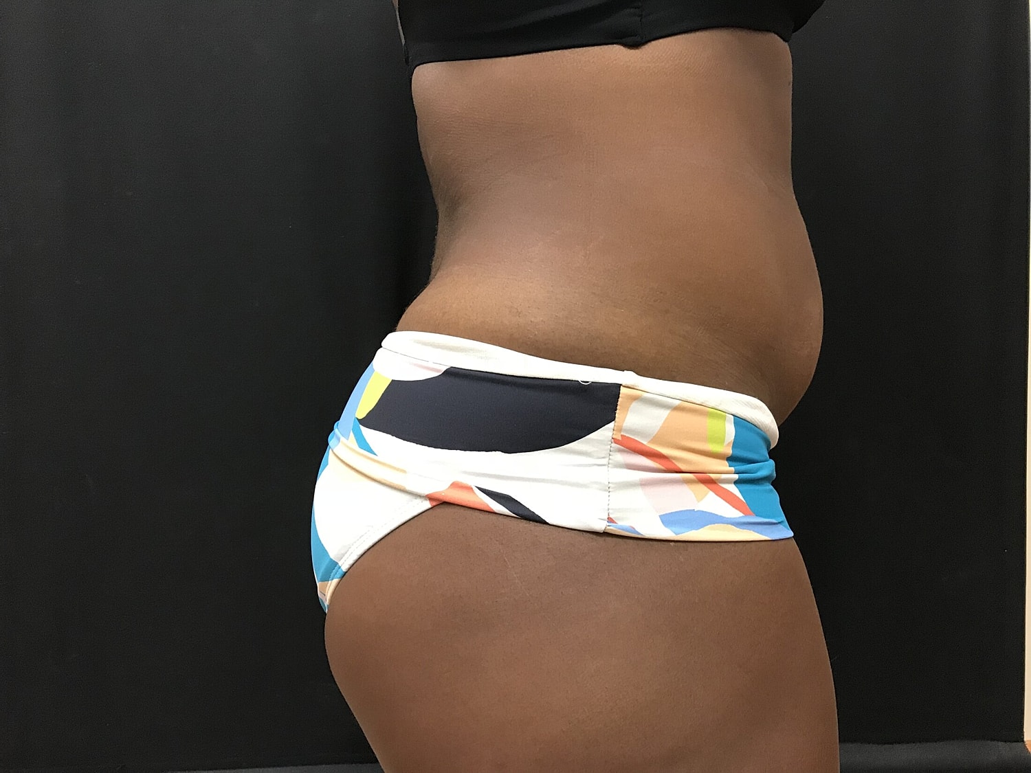 Tummy Tuck Before & After