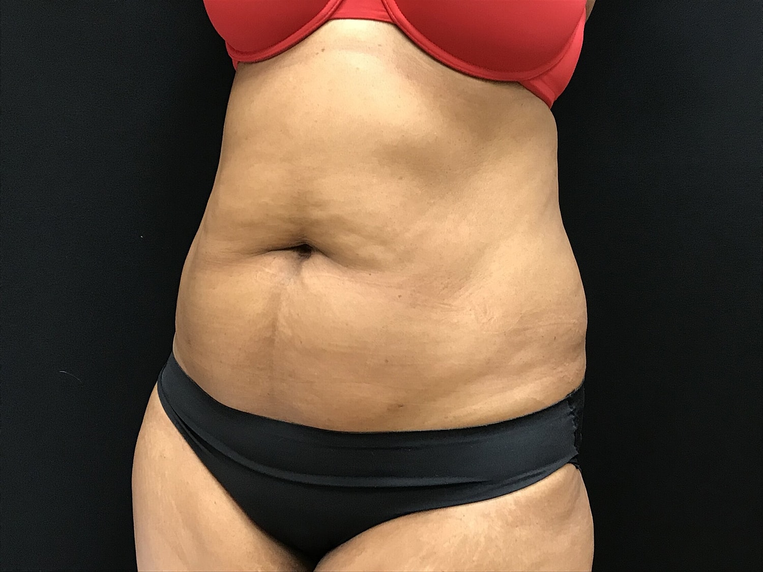 Tummy Tuck Before & After