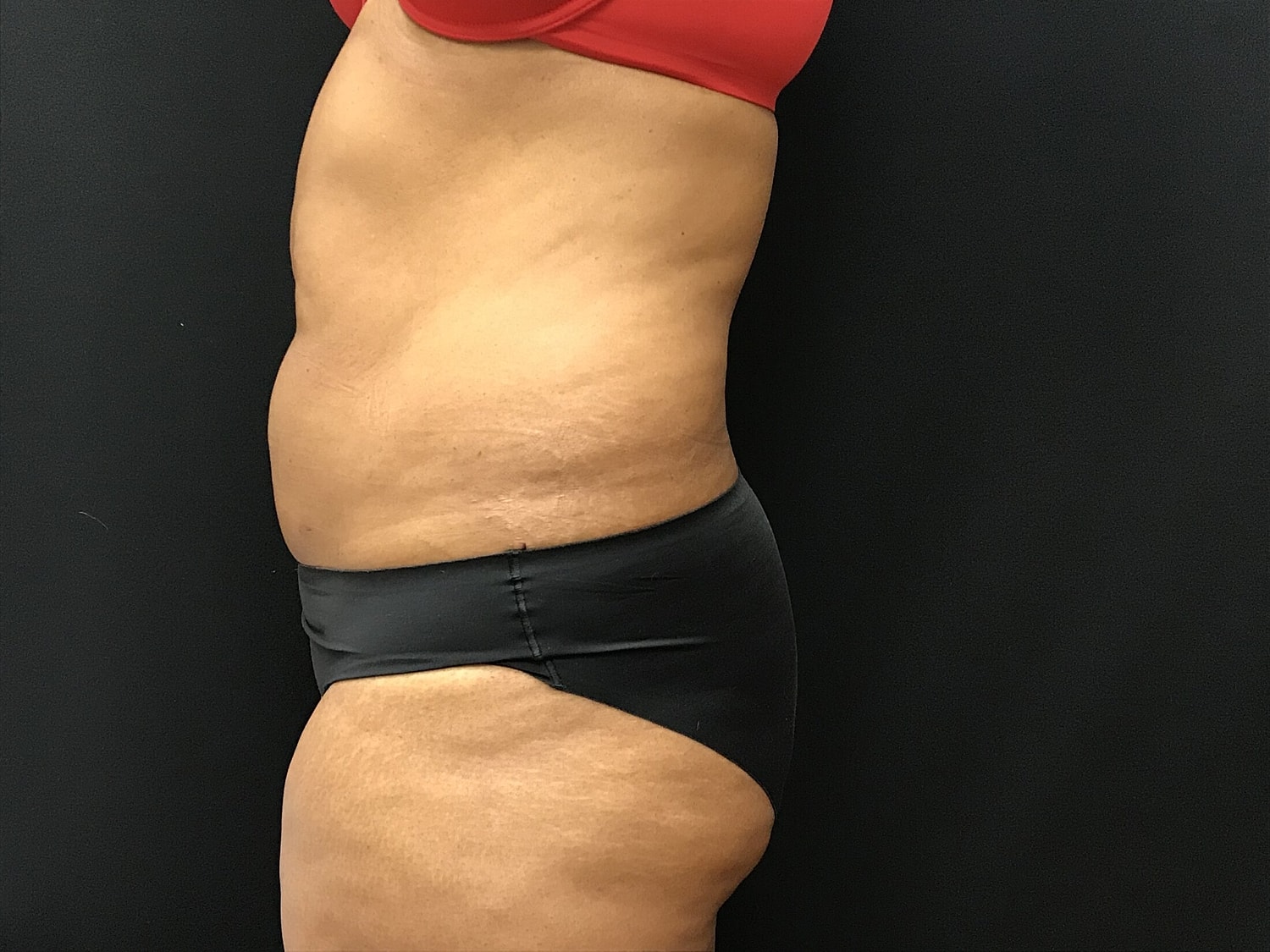 Tummy Tuck Before & After