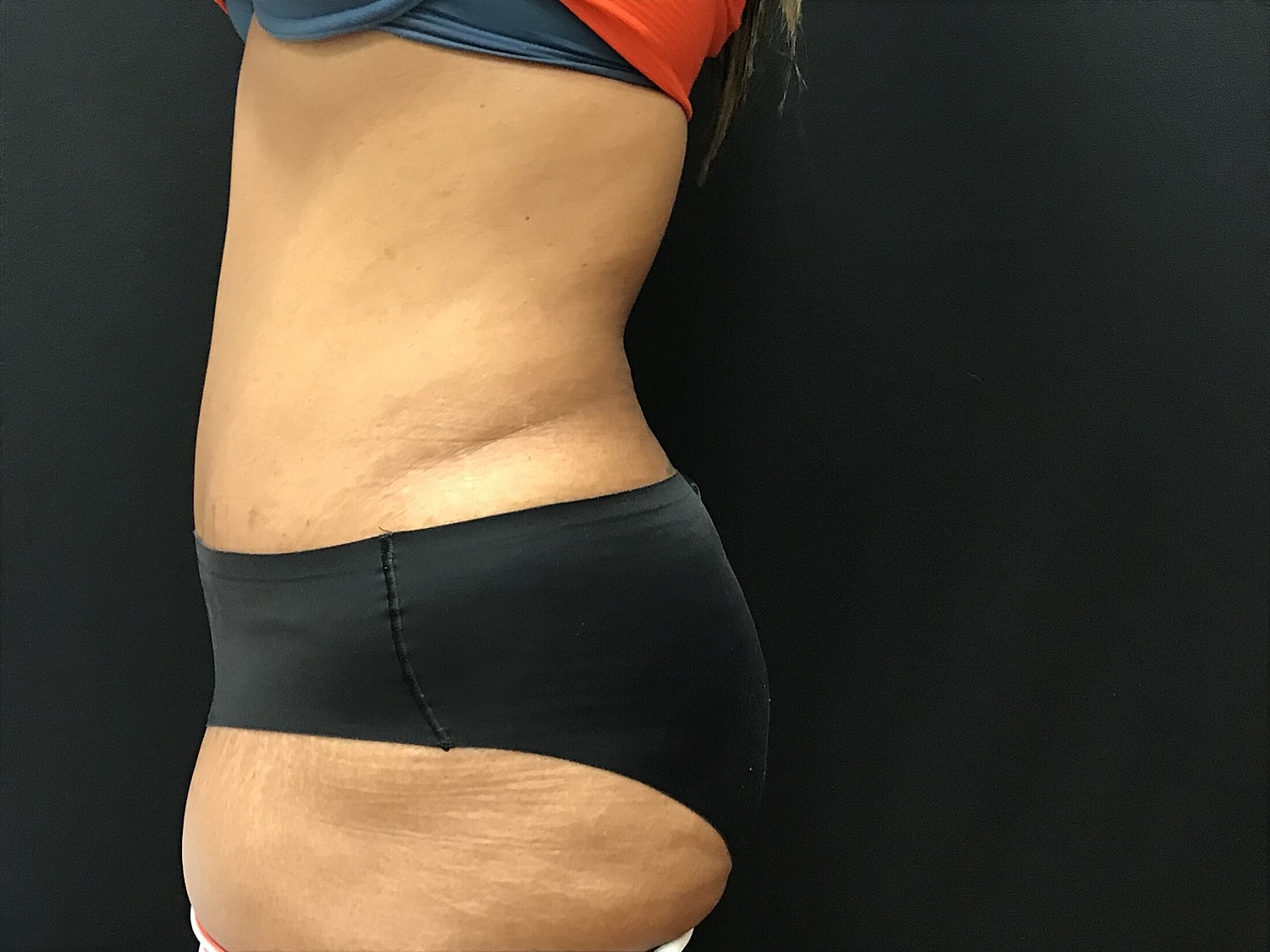 Tummy Tuck Before & After