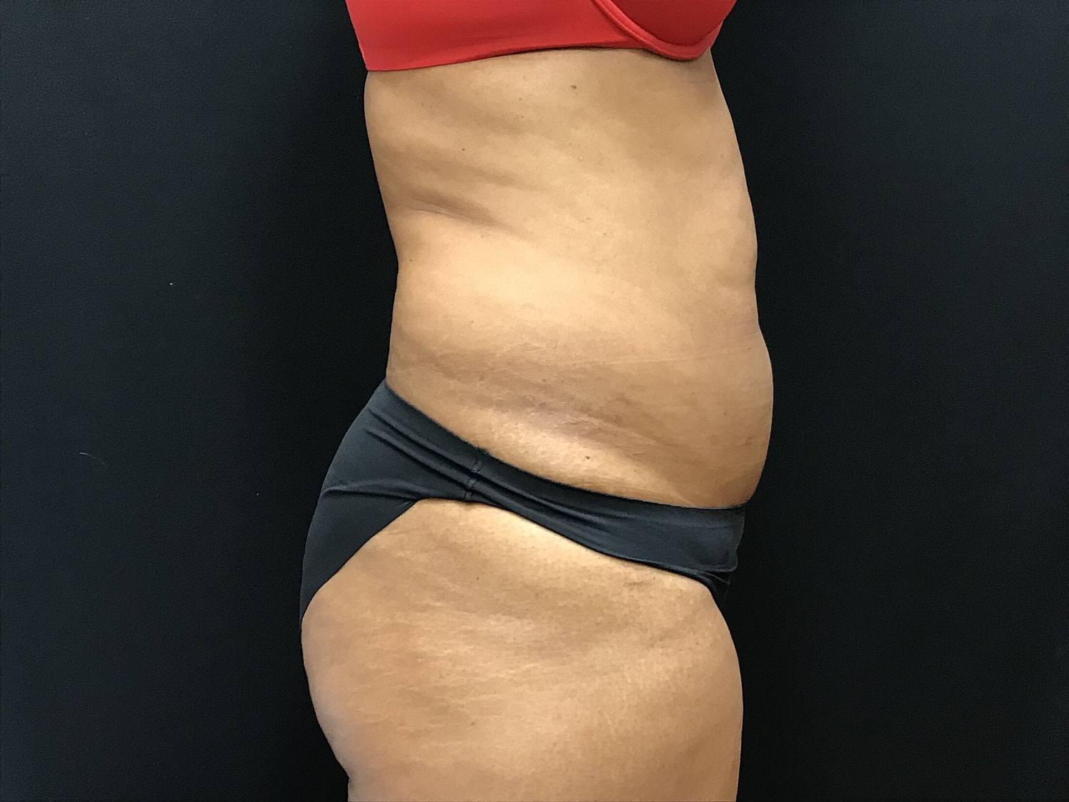 Tummy Tuck Before & After