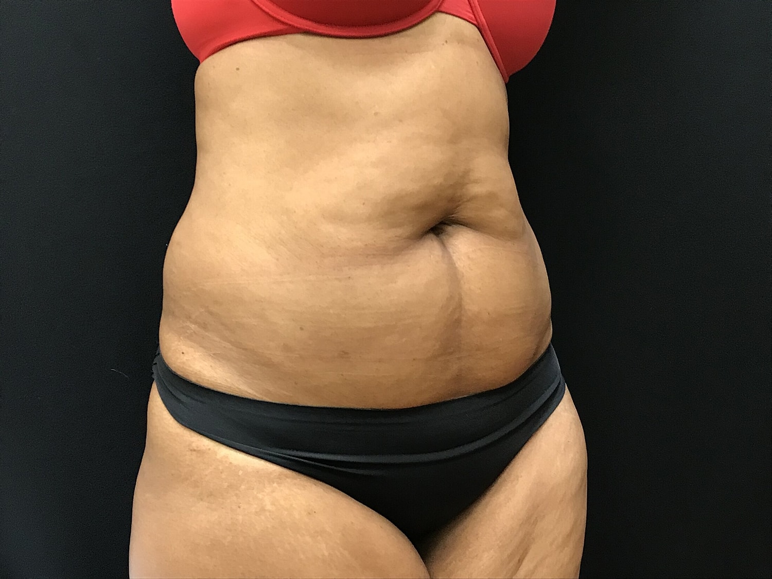 Tummy Tuck Before & After