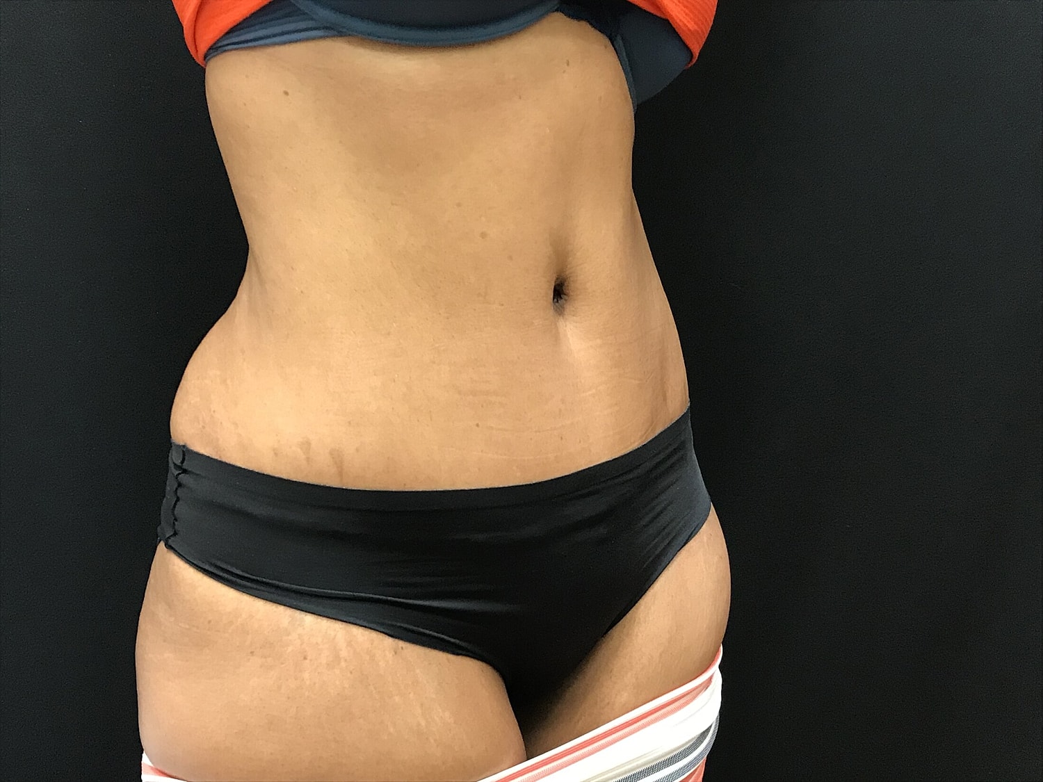 Tummy Tuck Before & After