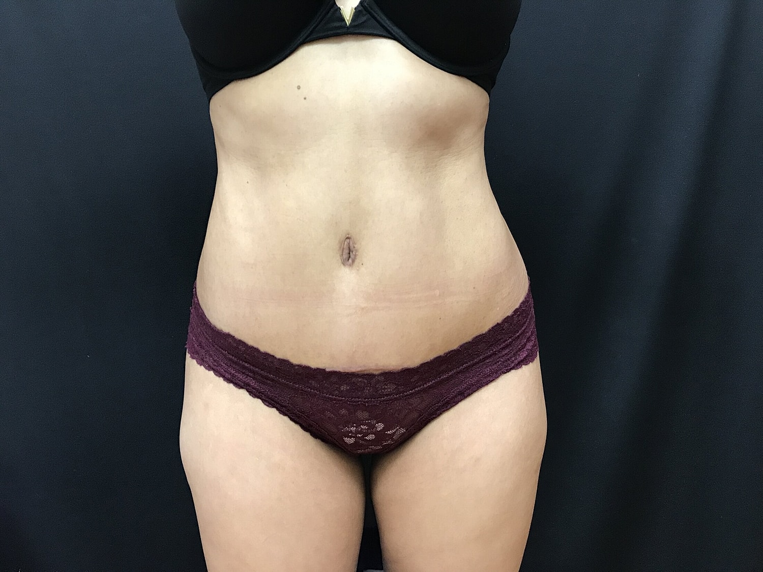 Tummy Tuck Before & After