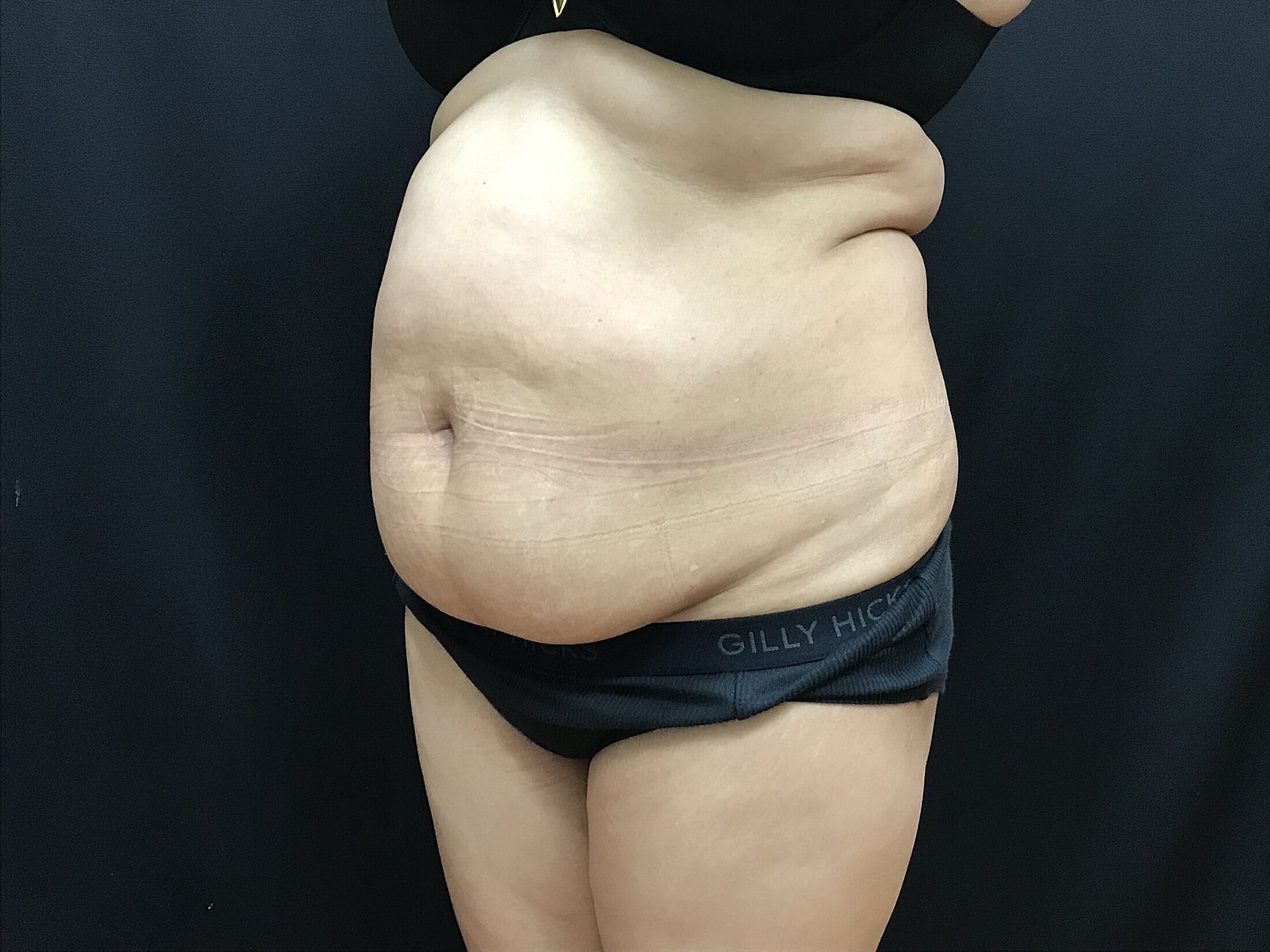 Tummy Tuck Before & After