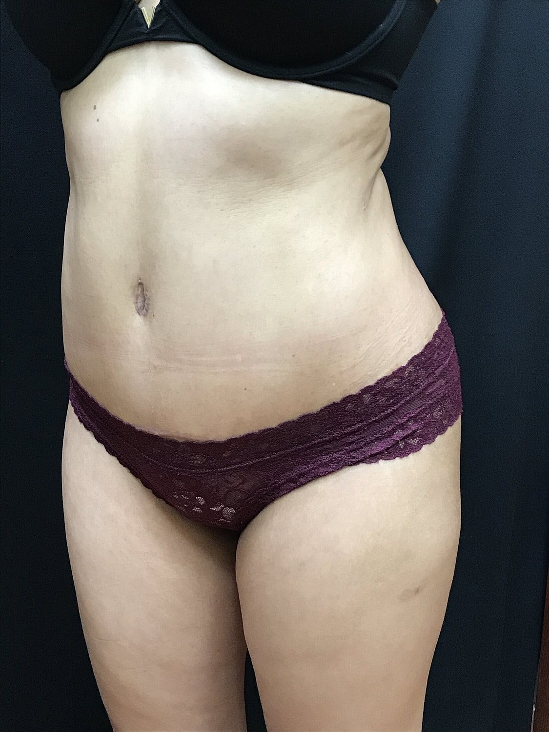 Tummy Tuck Before & After