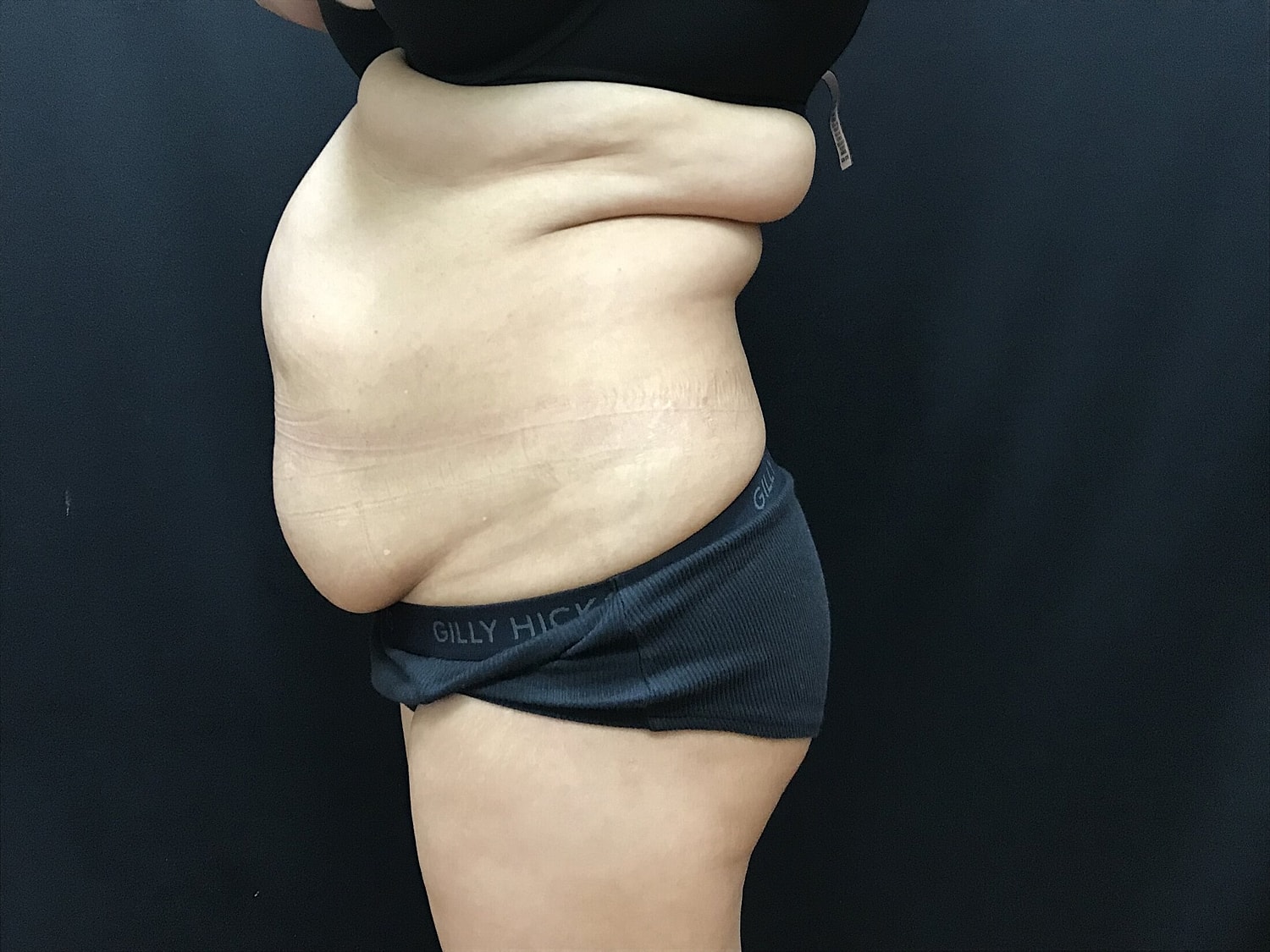 Tummy Tuck Before & After