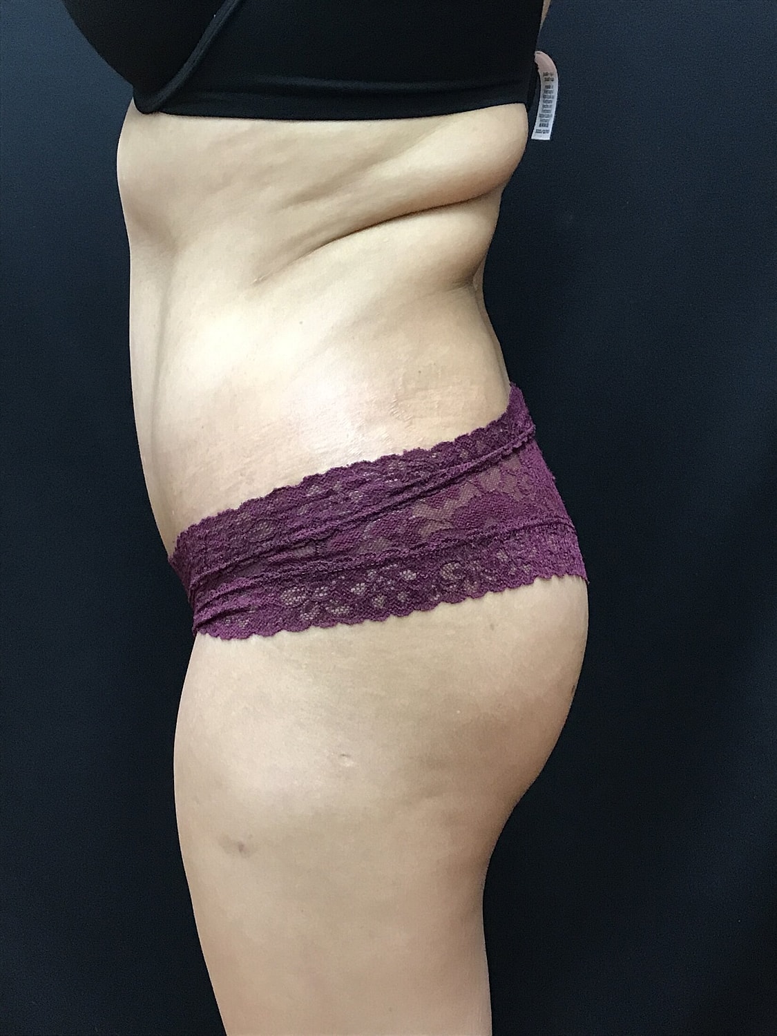 Tummy Tuck Before & After