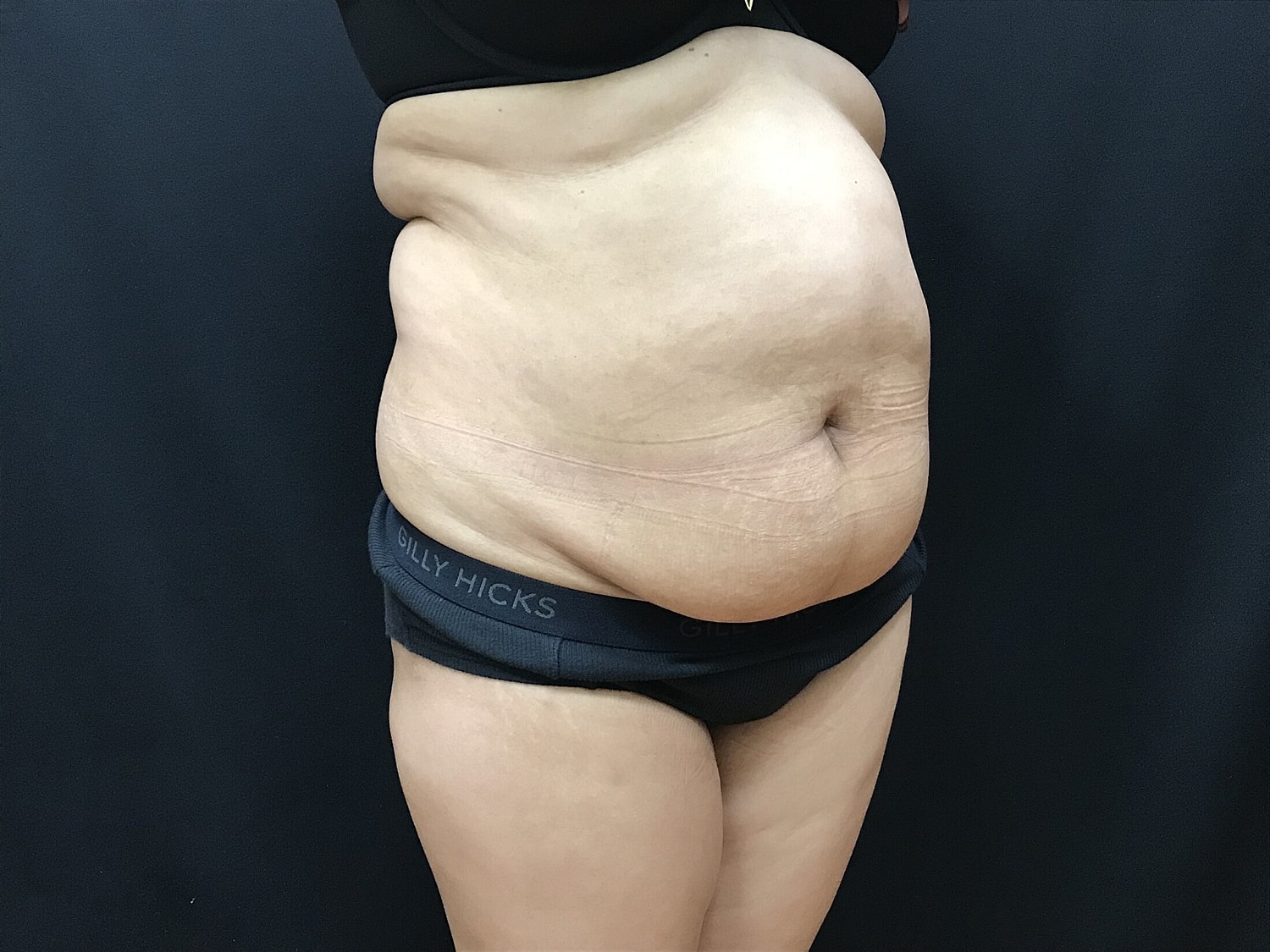 Tummy Tuck Before & After