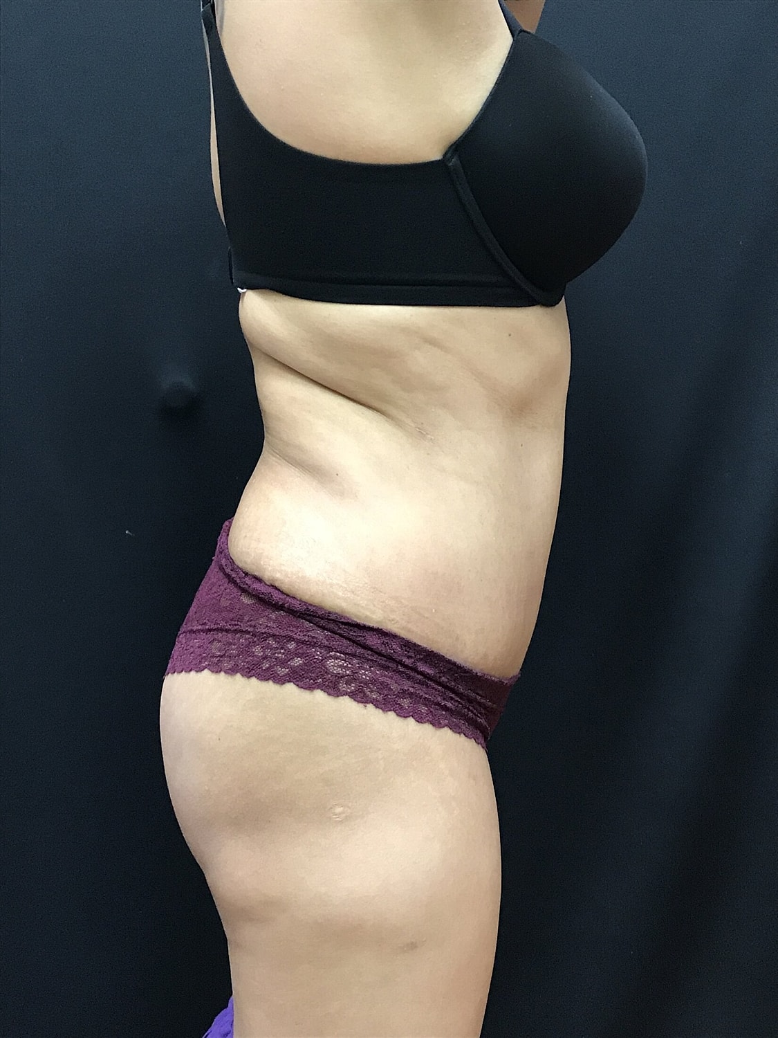 Tummy Tuck Before & After