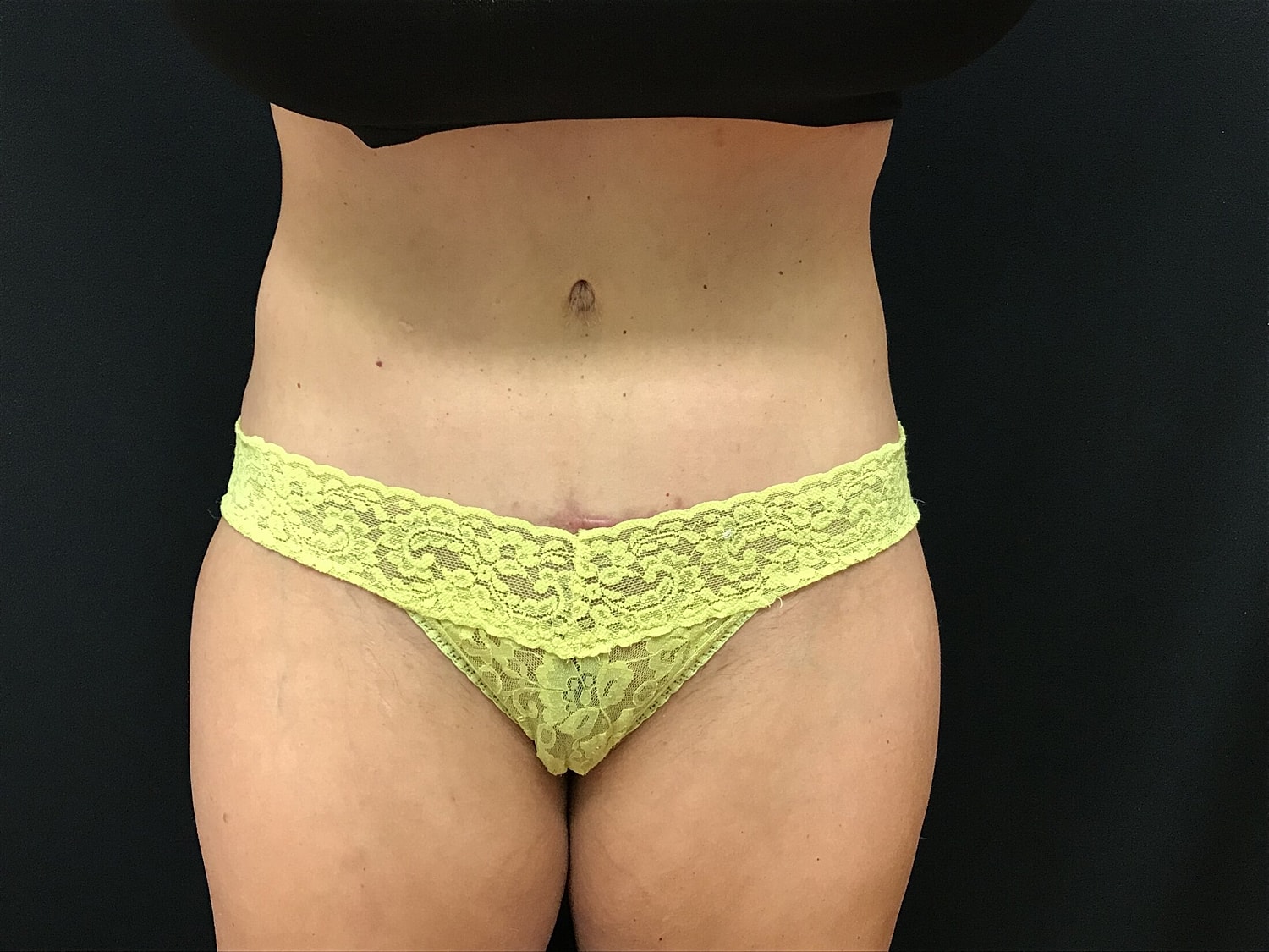 Tummy Tuck Before & After