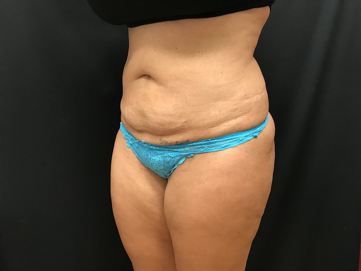 Tummy Tuck Before & After