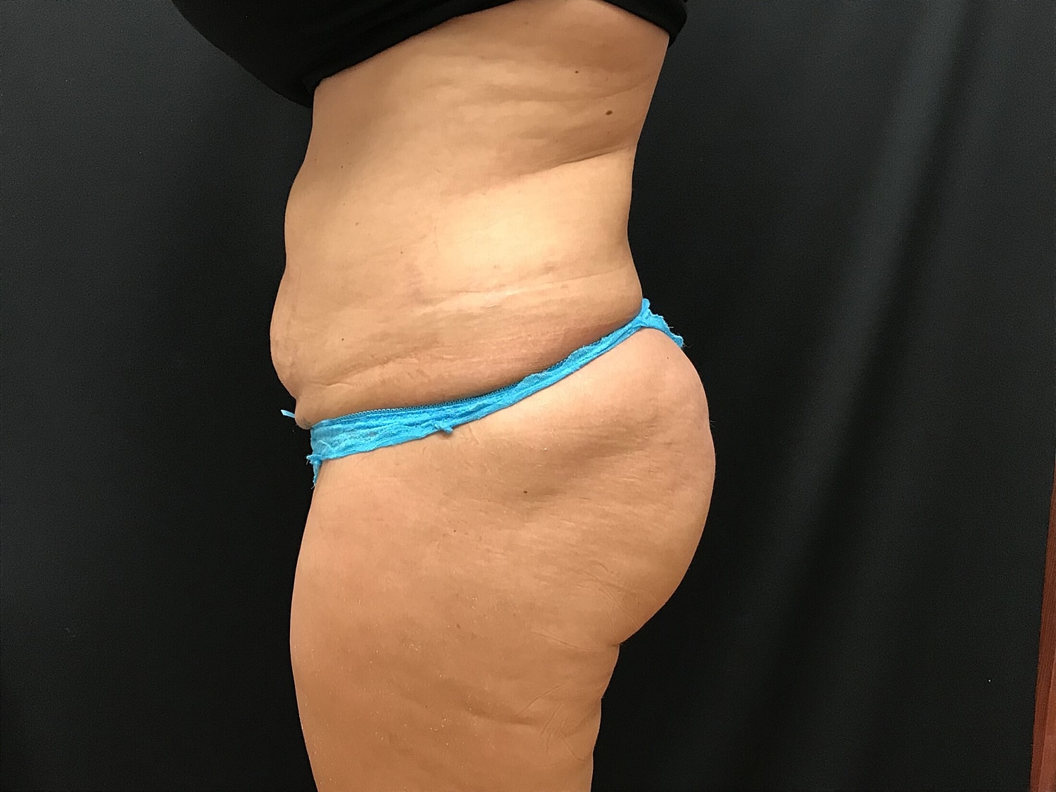 Tummy Tuck Before & After