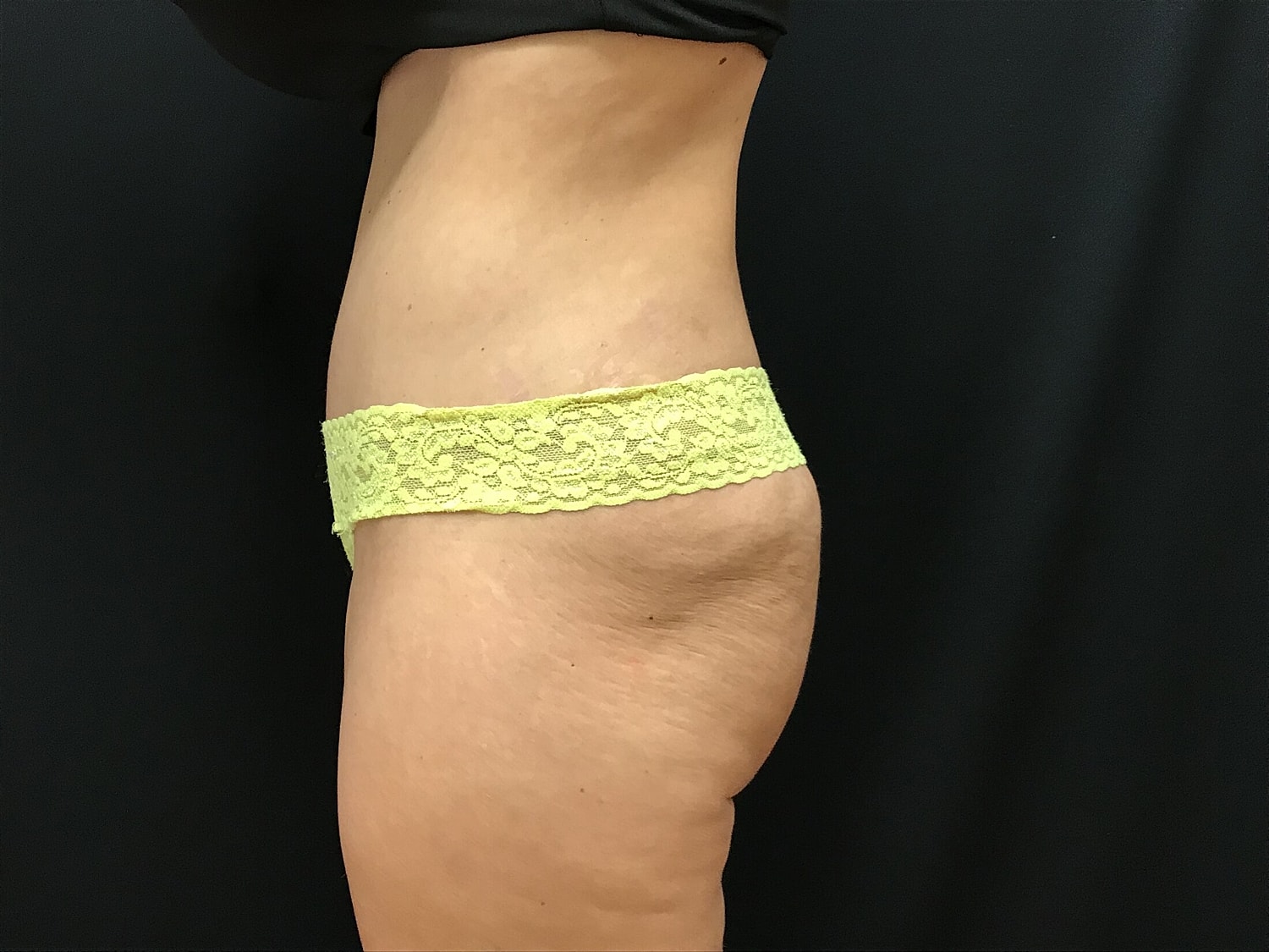 Tummy Tuck Before & After