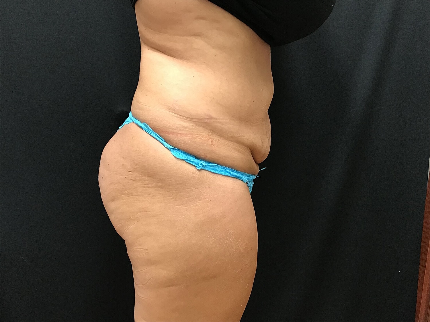 Tummy Tuck Before & After