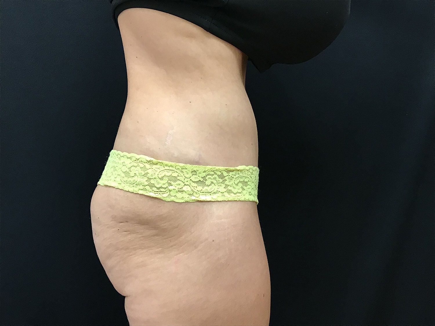 Tummy Tuck Before & After