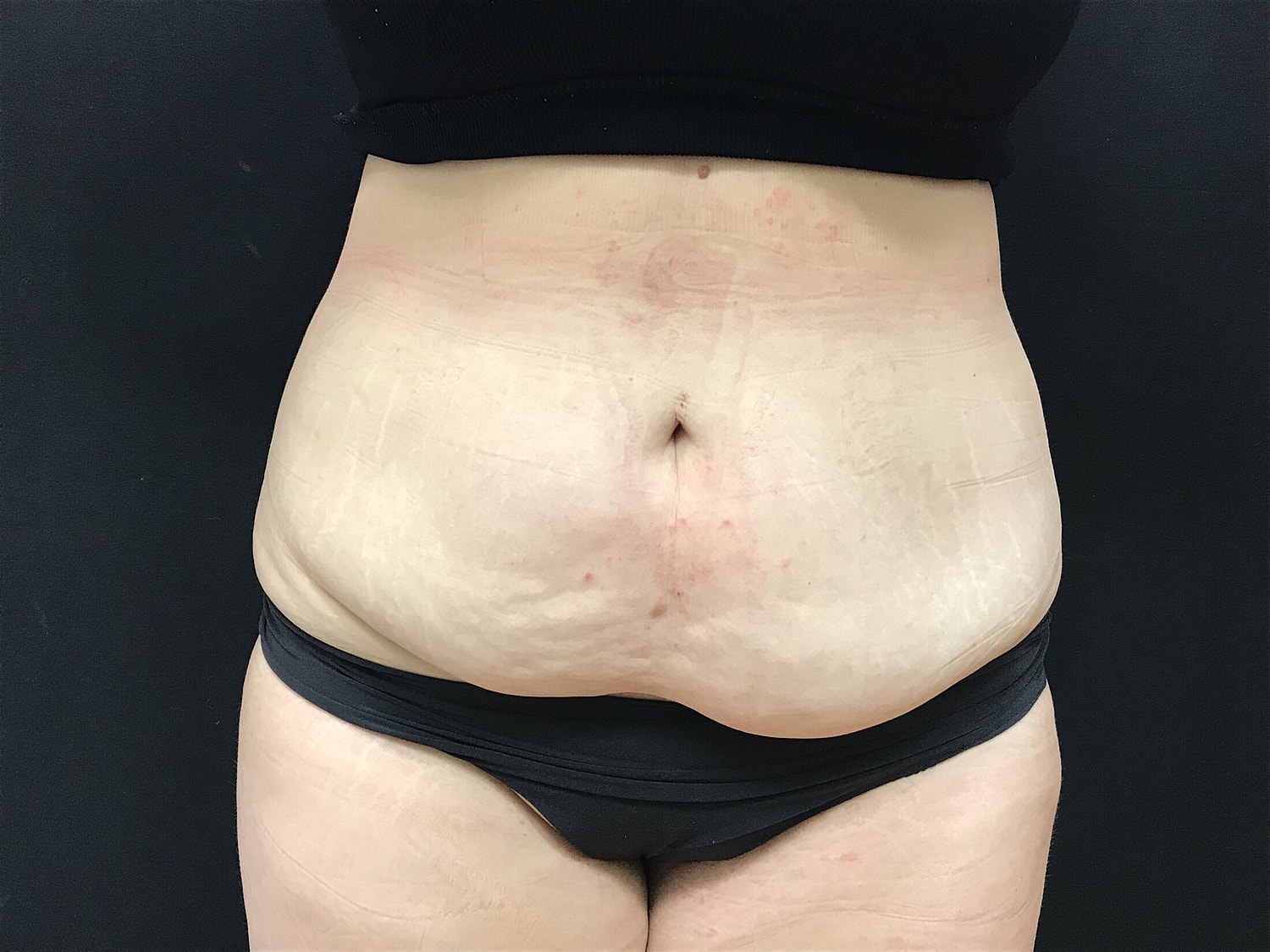 Tummy Tuck Before & After