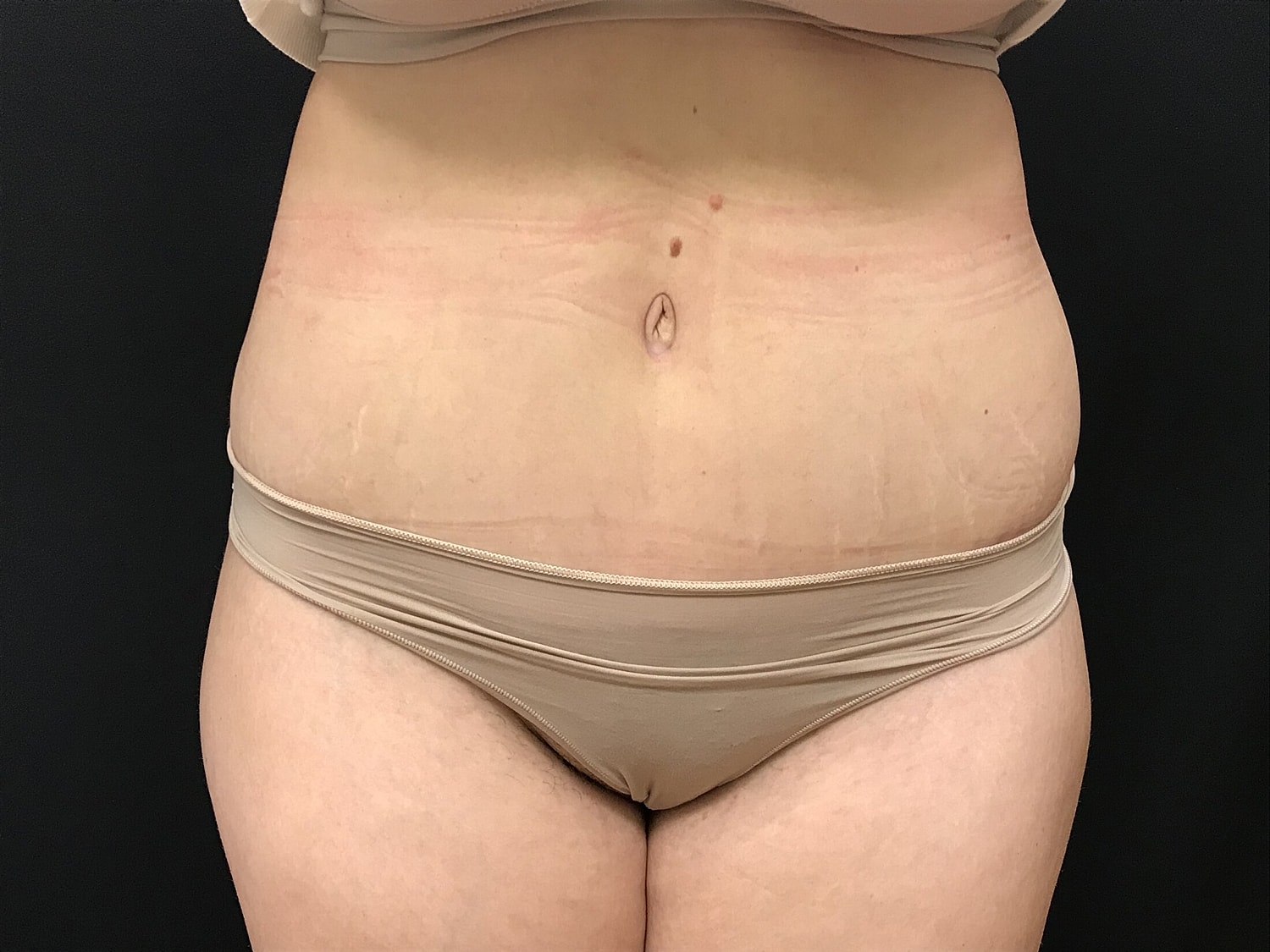 Tummy Tuck Before & After