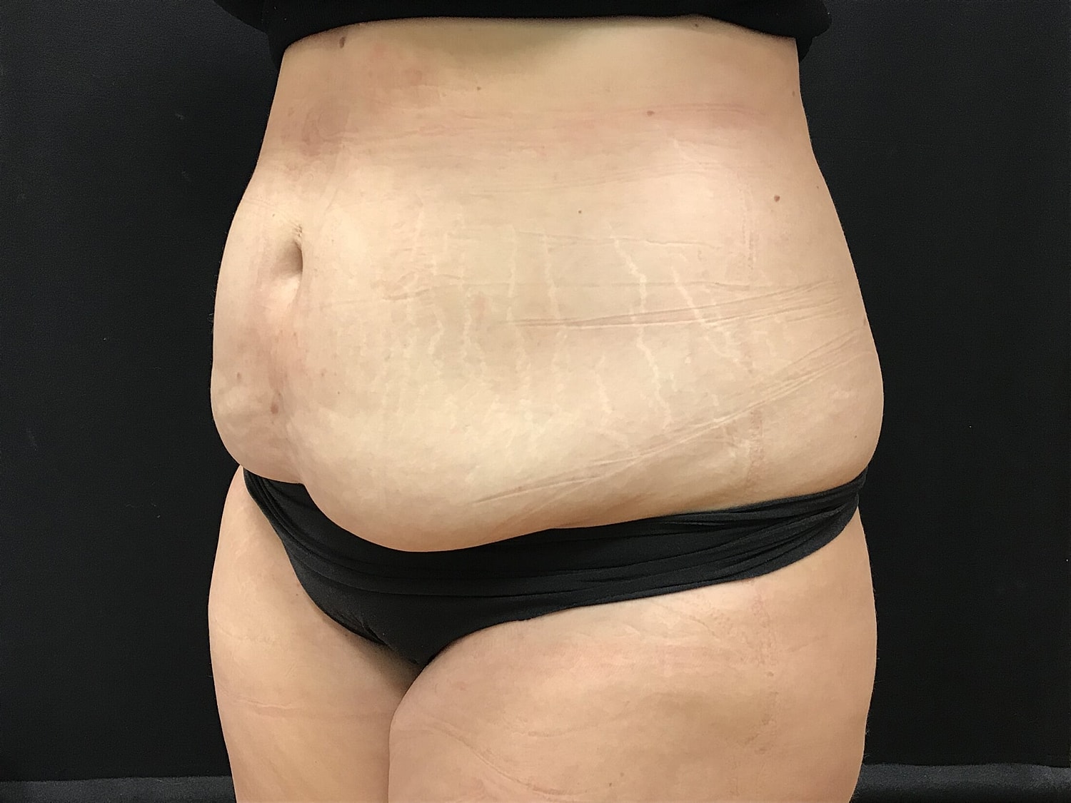 Tummy Tuck Before & After