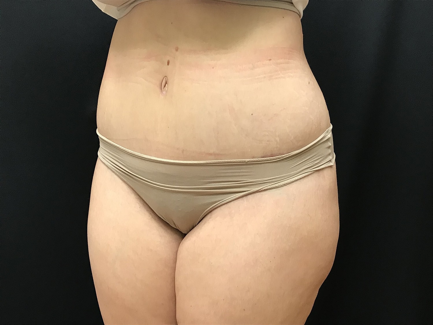 Tummy Tuck Before & After