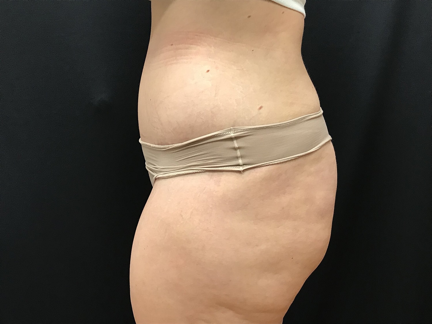 Tummy Tuck Before & After