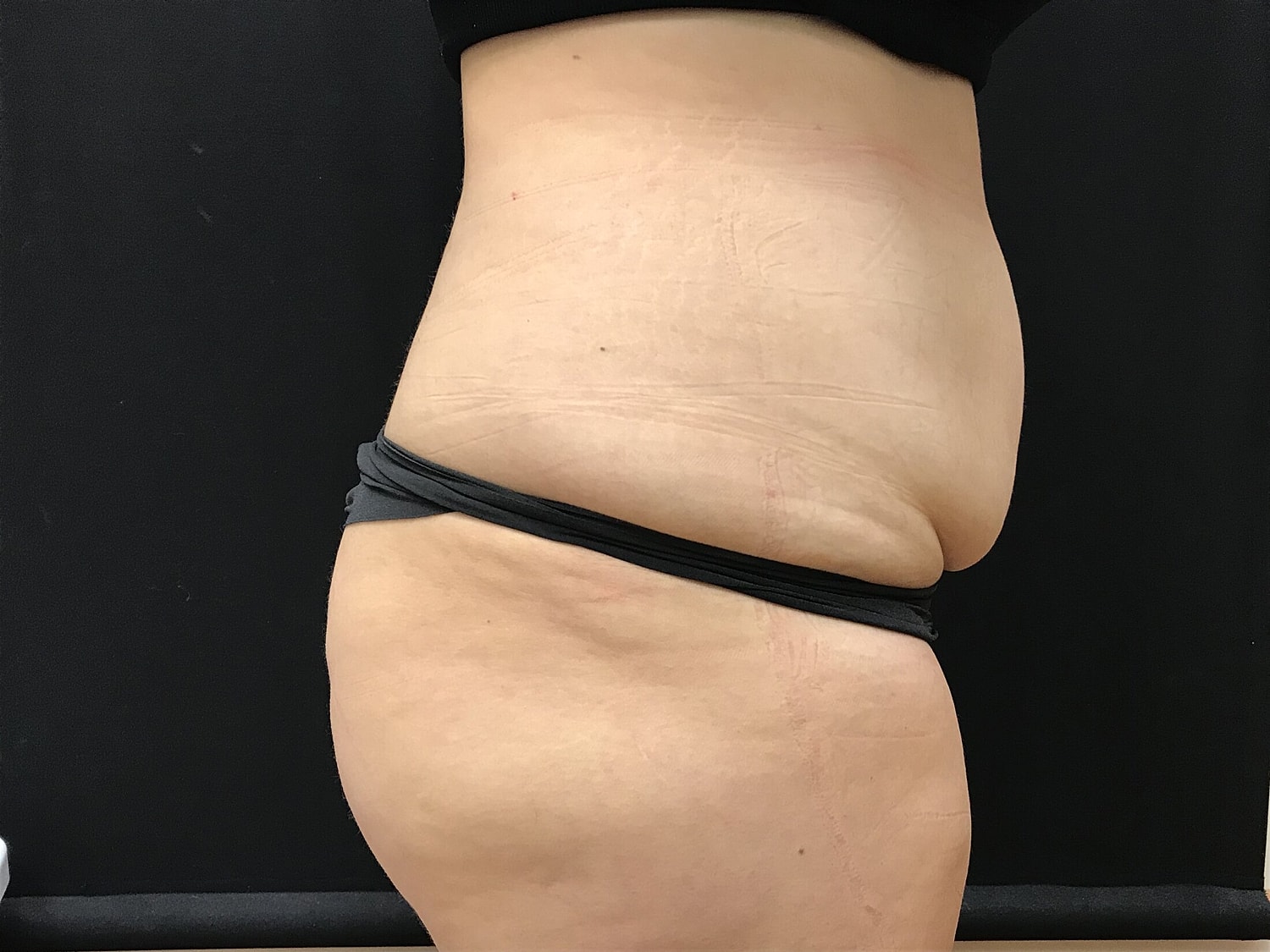Tummy Tuck Before & After