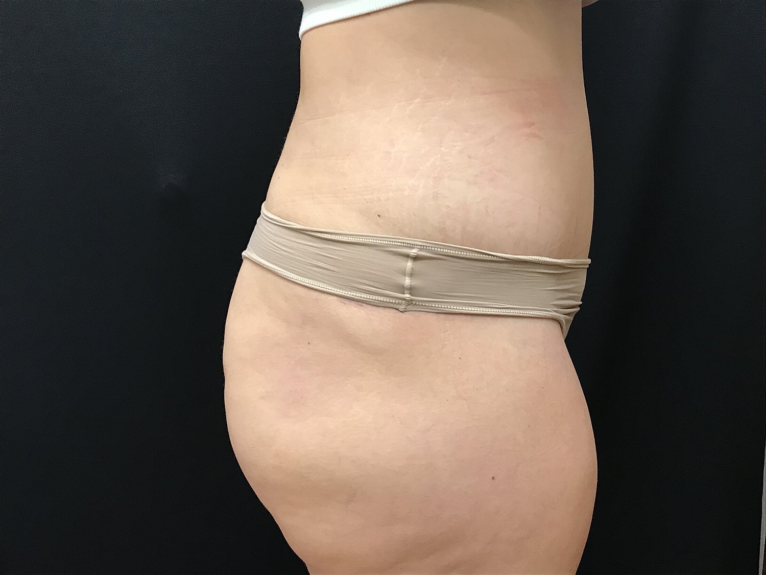 Tummy Tuck Before & After