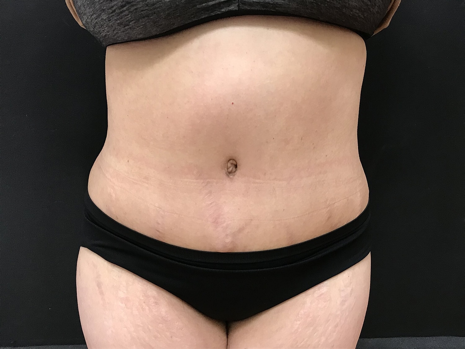 Tummy Tuck Before & After