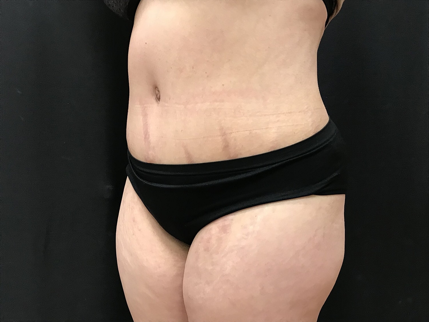 Tummy Tuck Before & After