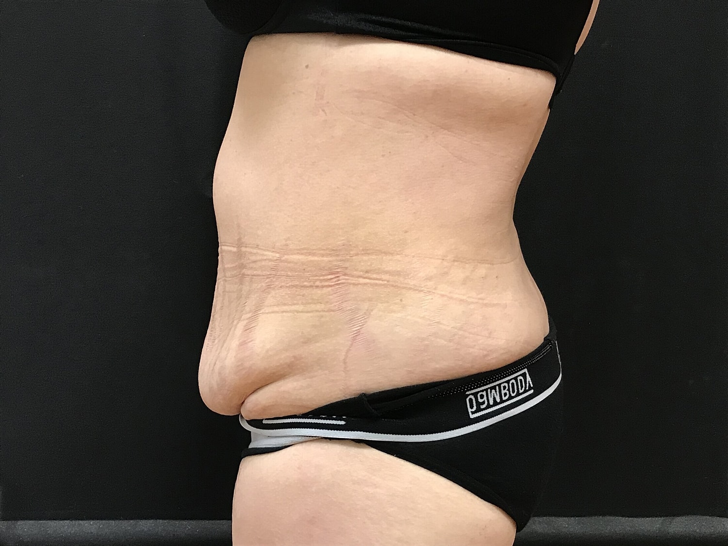 Tummy Tuck Before & After