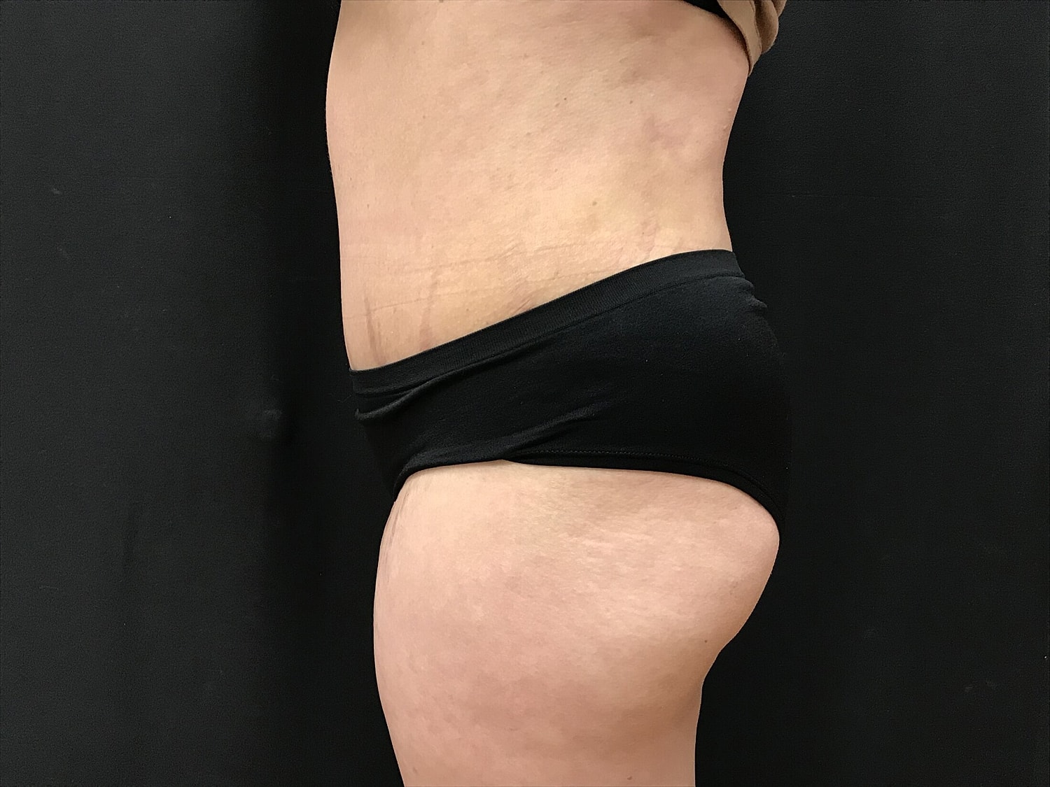 Tummy Tuck Before & After