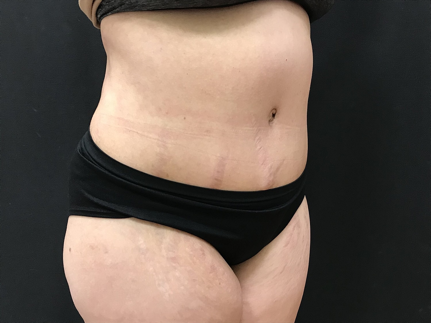 Tummy Tuck Before & After
