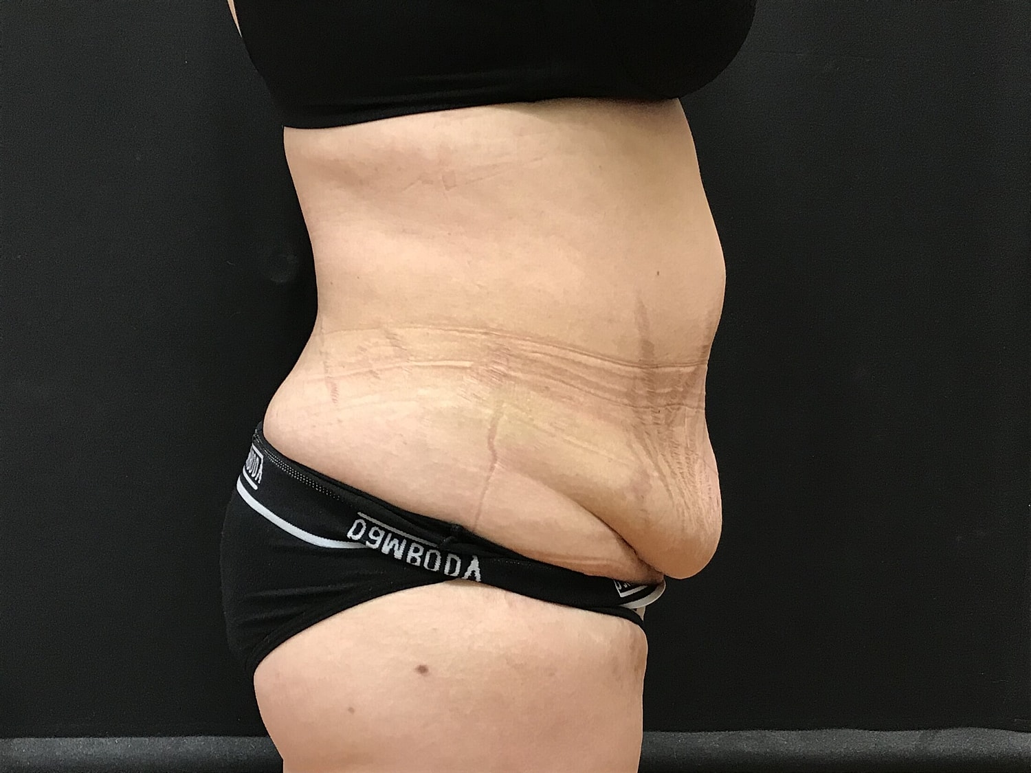 Tummy Tuck Before & After