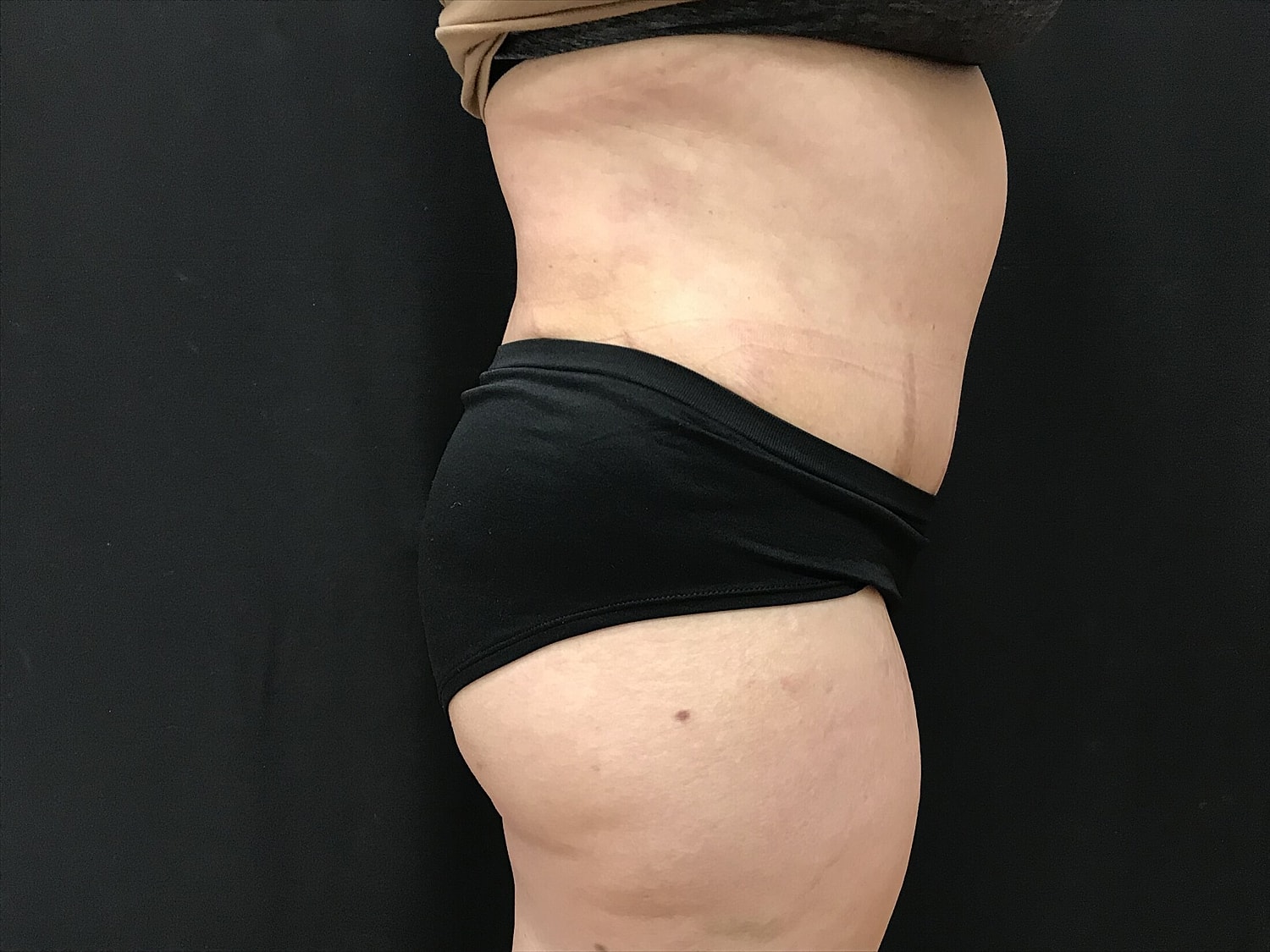 Tummy Tuck Before & After