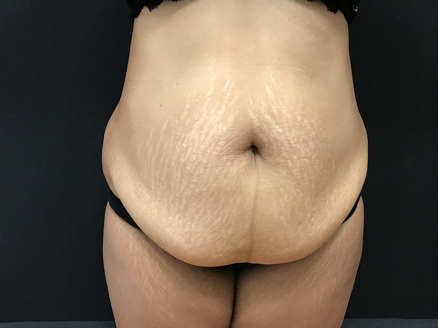 Tummy Tuck Before & After