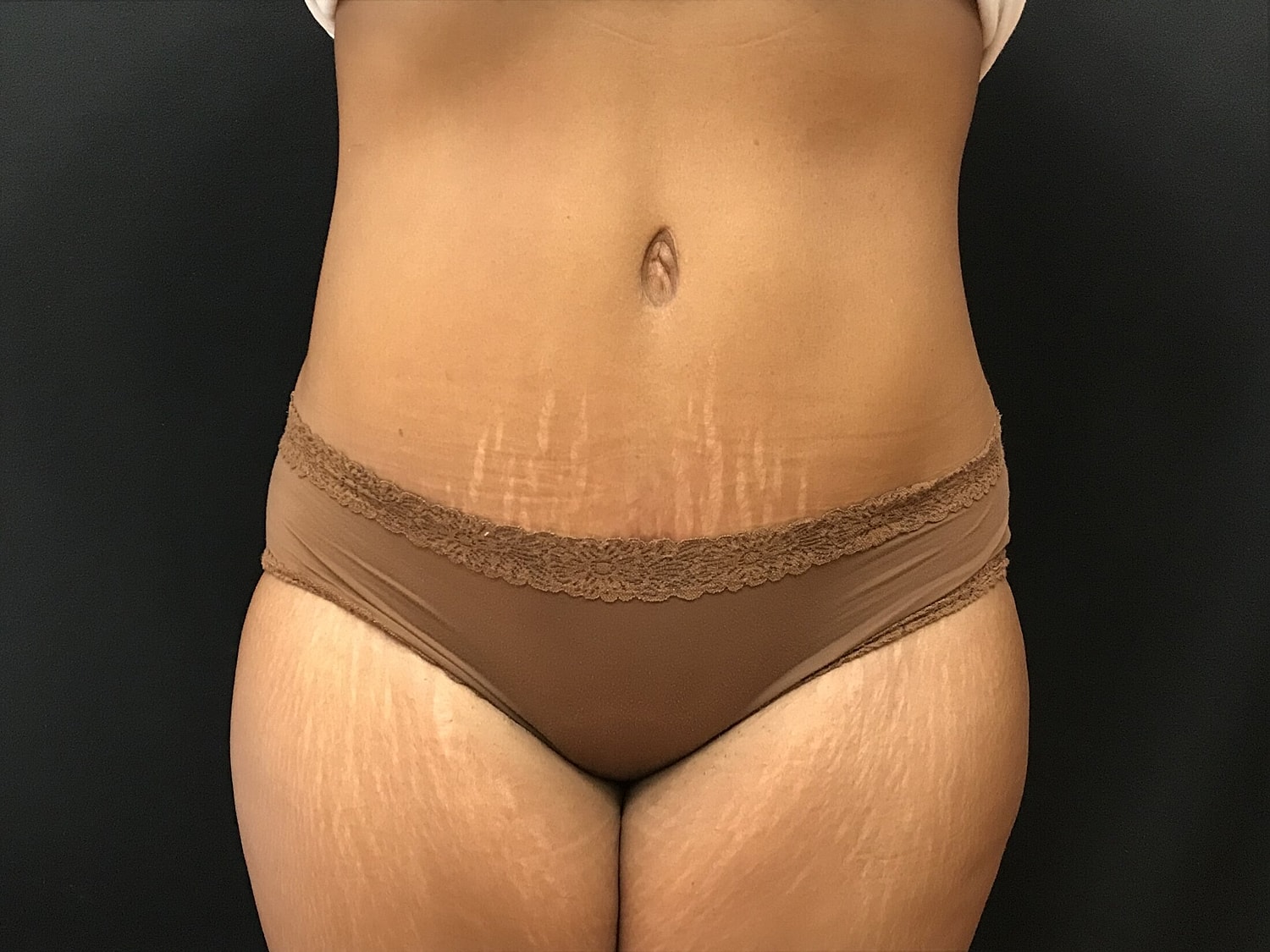 Tummy Tuck Before & After