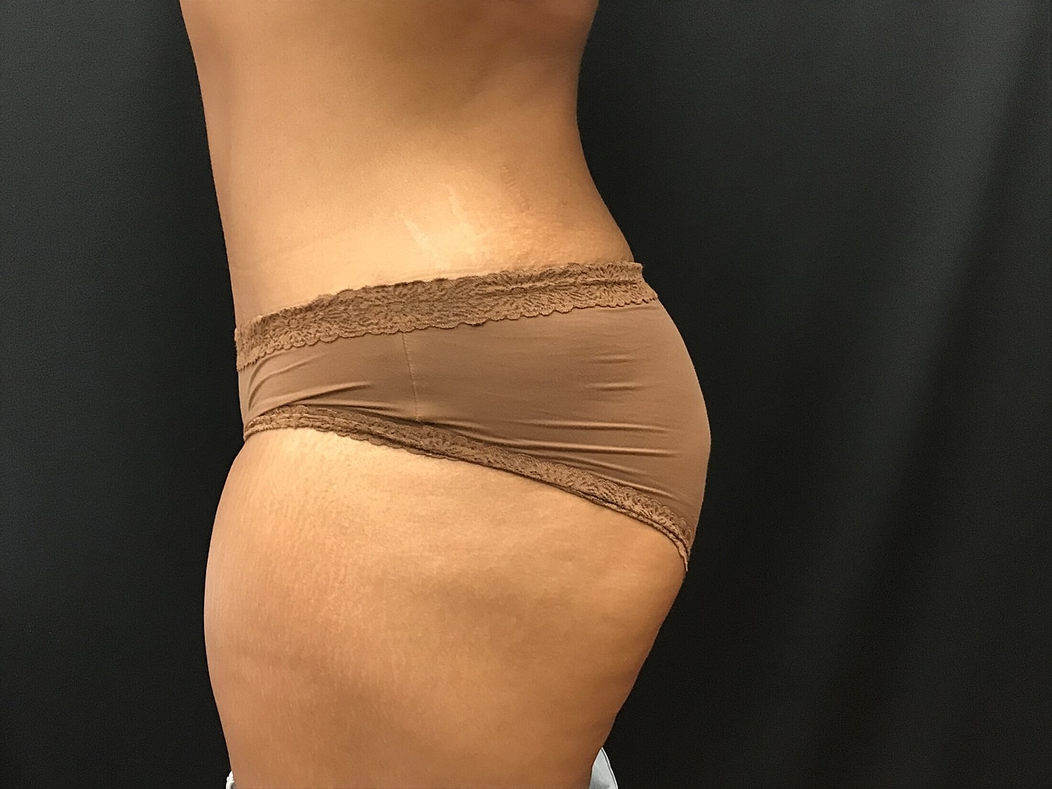 Tummy Tuck Before & After