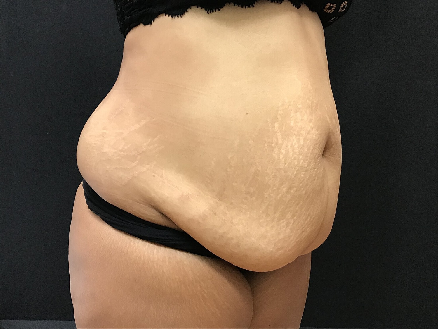 Tummy Tuck Before & After