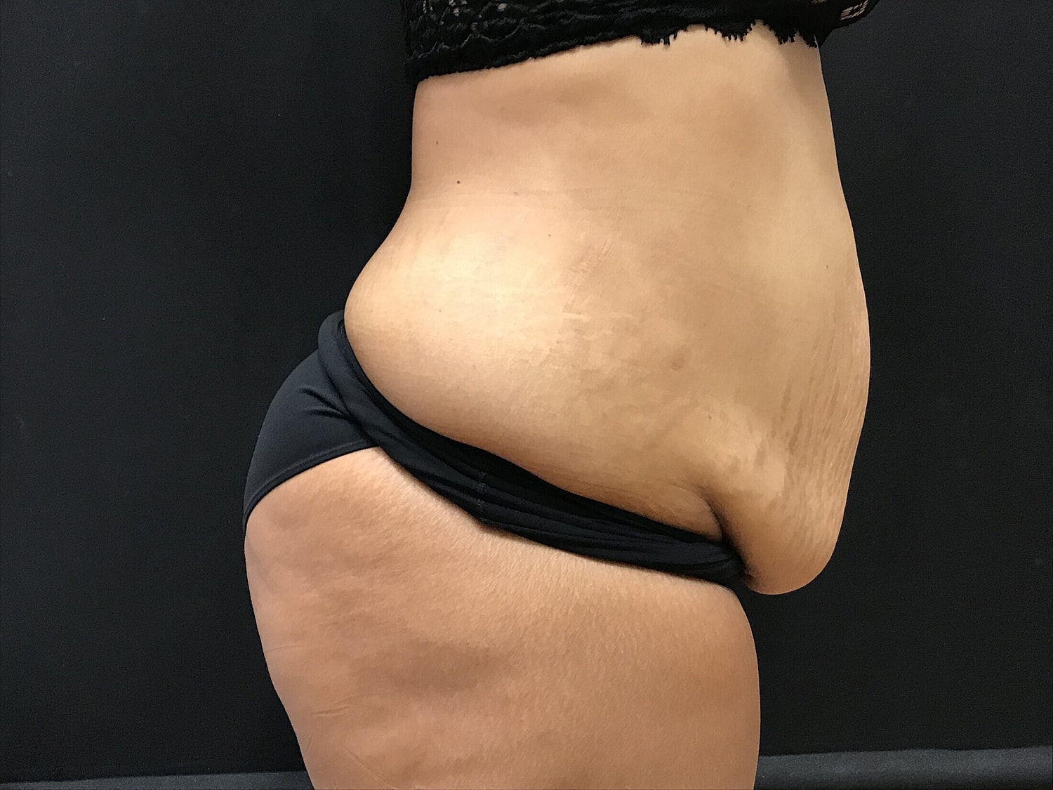 Tummy Tuck Before & After