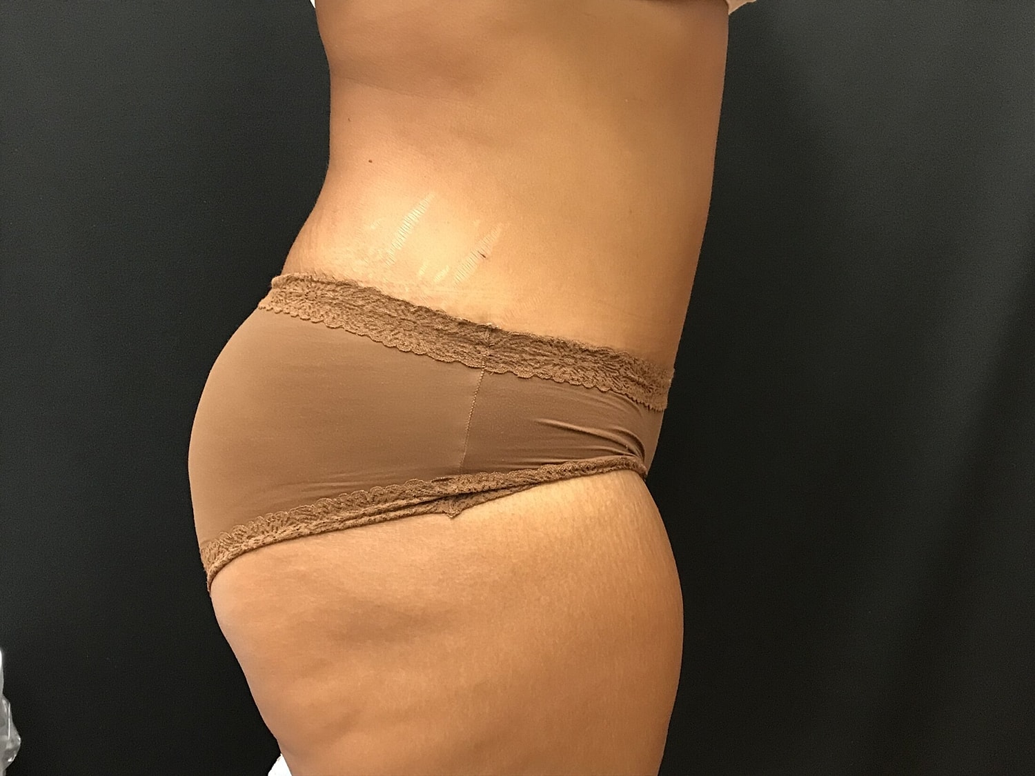 Tummy Tuck Before & After