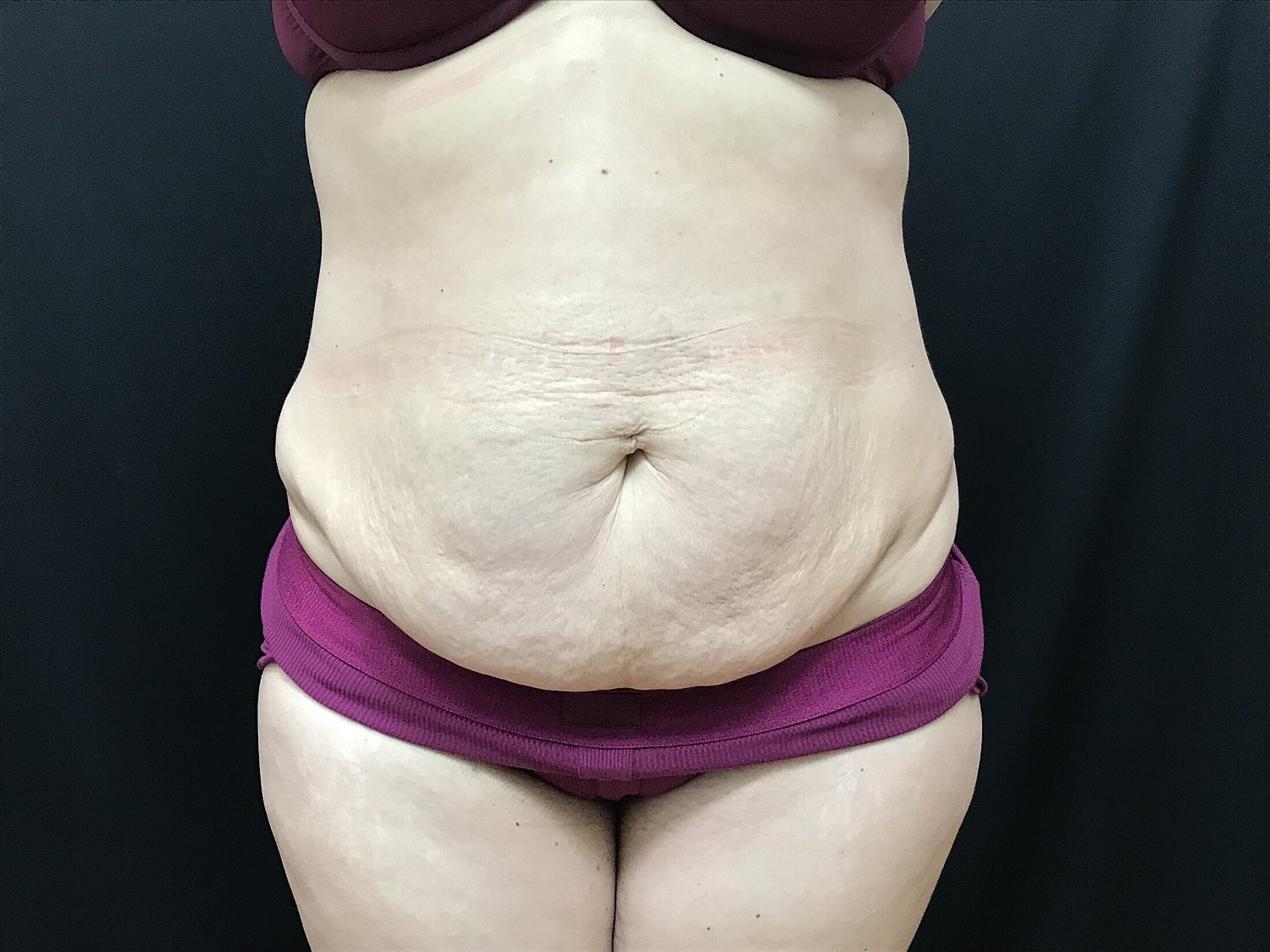 Tummy Tuck Before & After