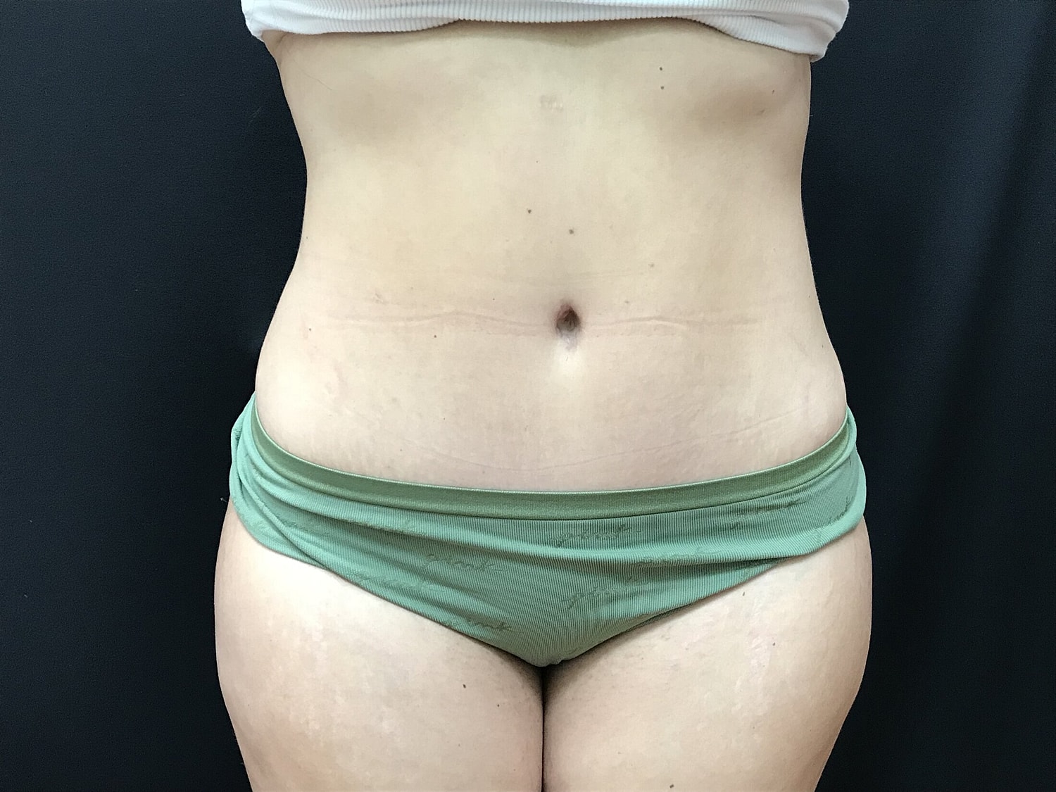 Tummy Tuck Before & After