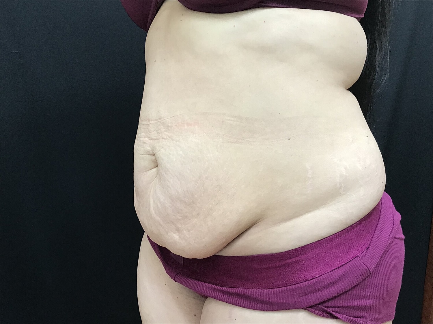 Tummy Tuck Before & After