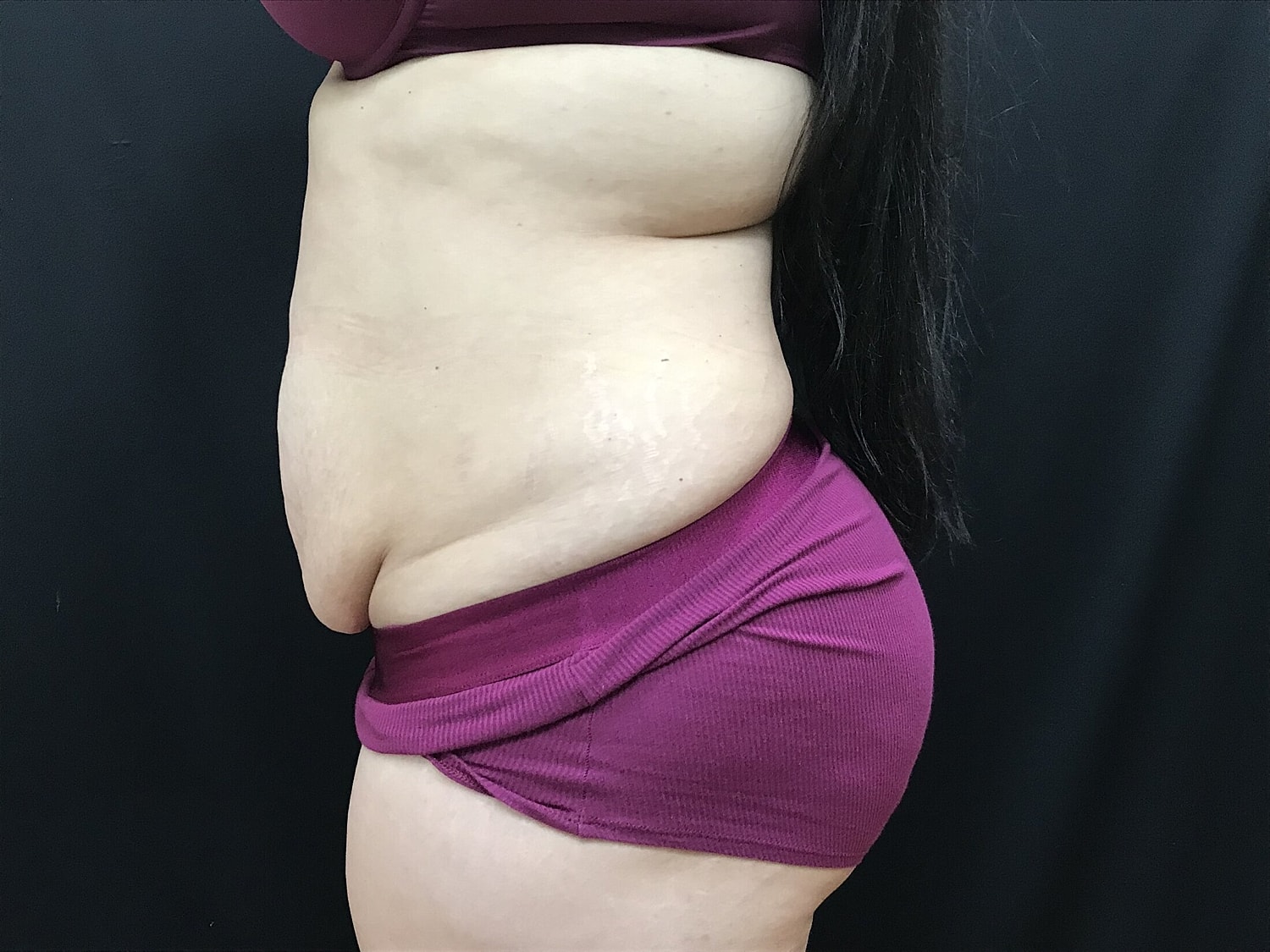 Tummy Tuck Before & After